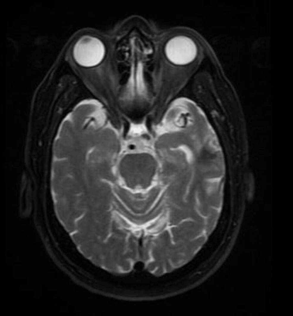 Cureus Brain Abscesses By Nocardia An Interesting Case