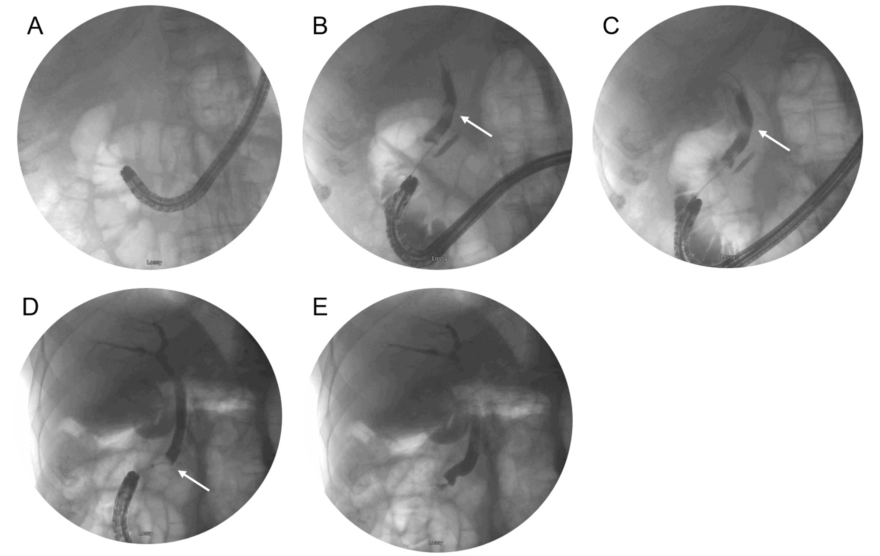 Cureus | A Change in Scope: Endoscopic Retrograde ...