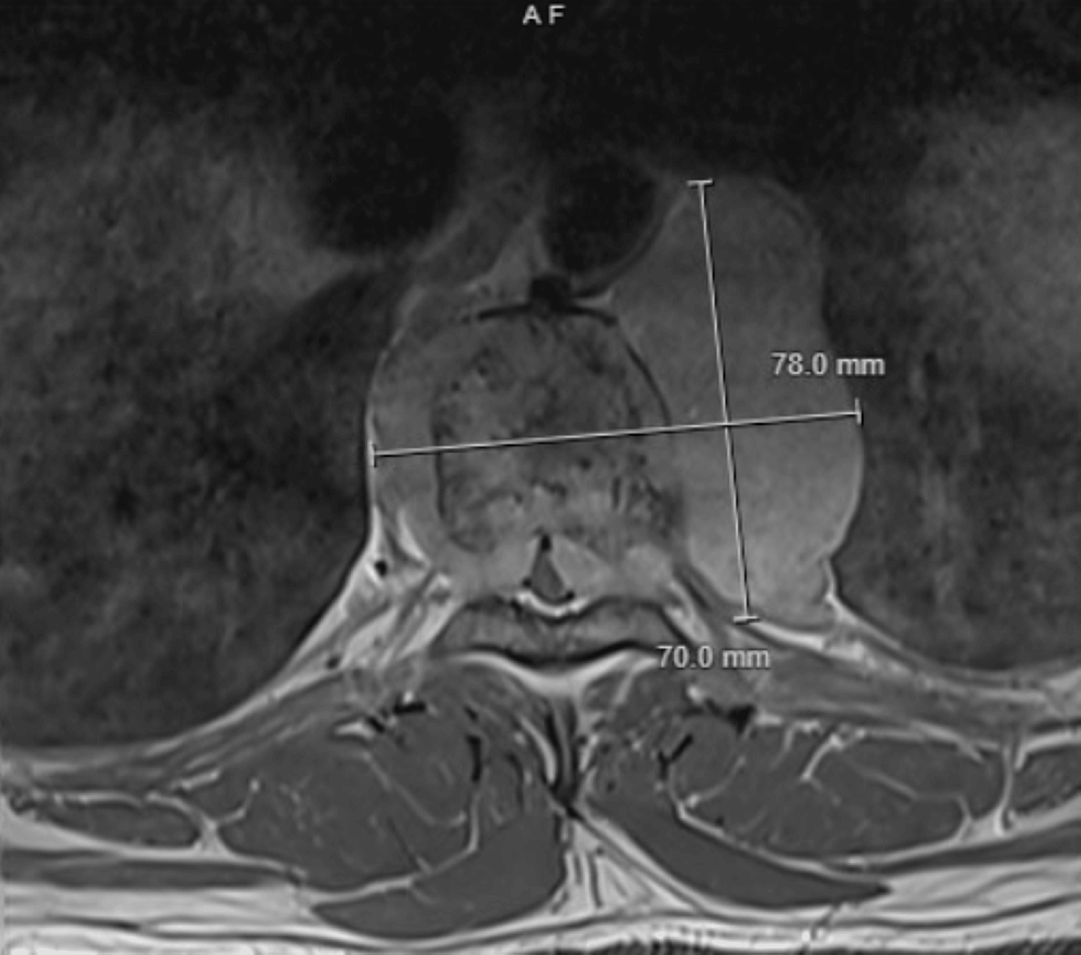 Cureus | Solitary Plasmacytoma of the Spine in a Young Male and the ...