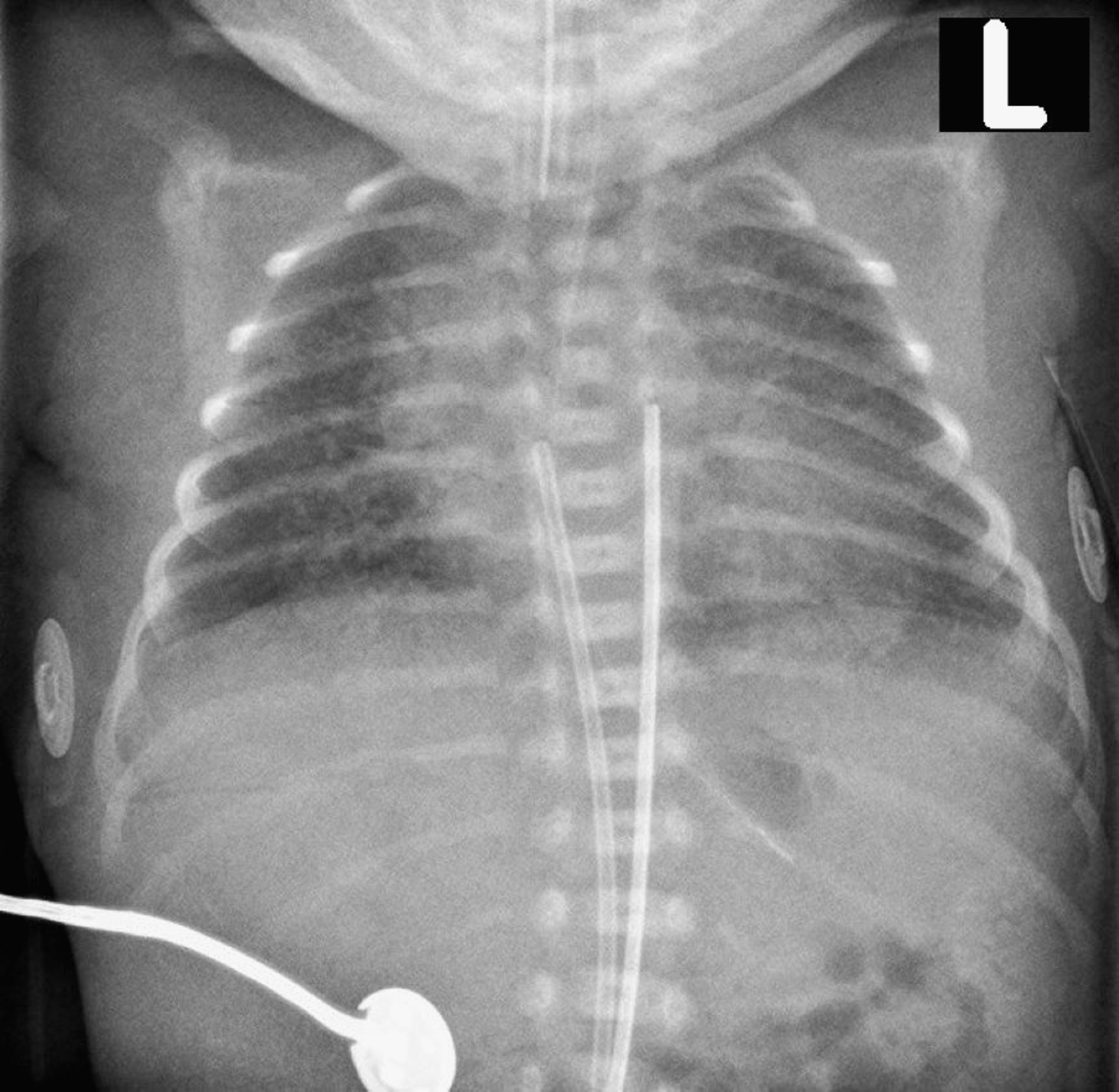 Cureus | Successful Management of a Ruptured Interstitial Pregnancy: A ...