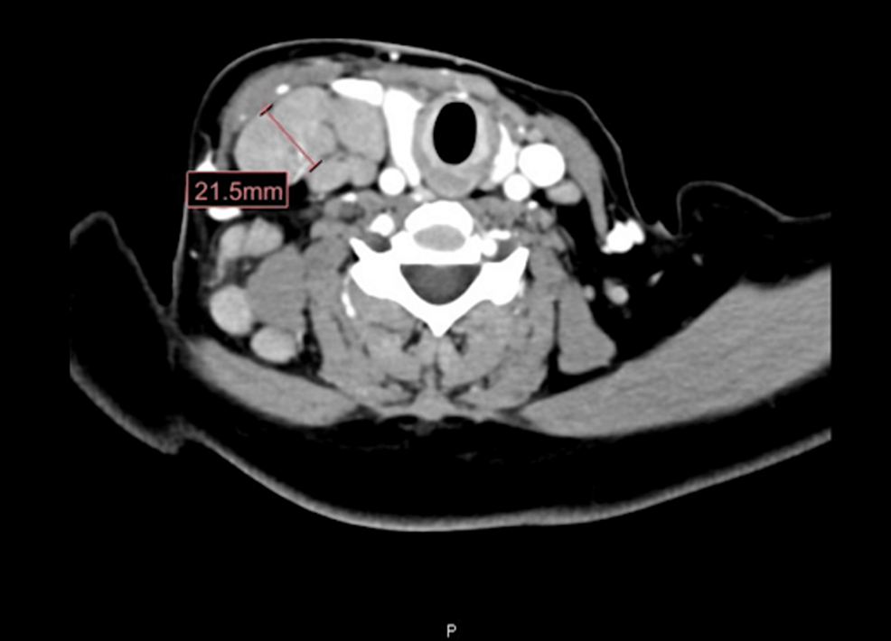 Cureus | A Rare Cause of Lymphadenopathy in a Young Hispanic Female ...