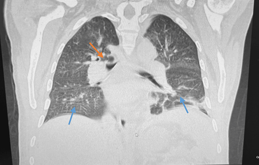 Cureus Giant Renal Cell Carcinoma (RCC) A Case Report of Delayed