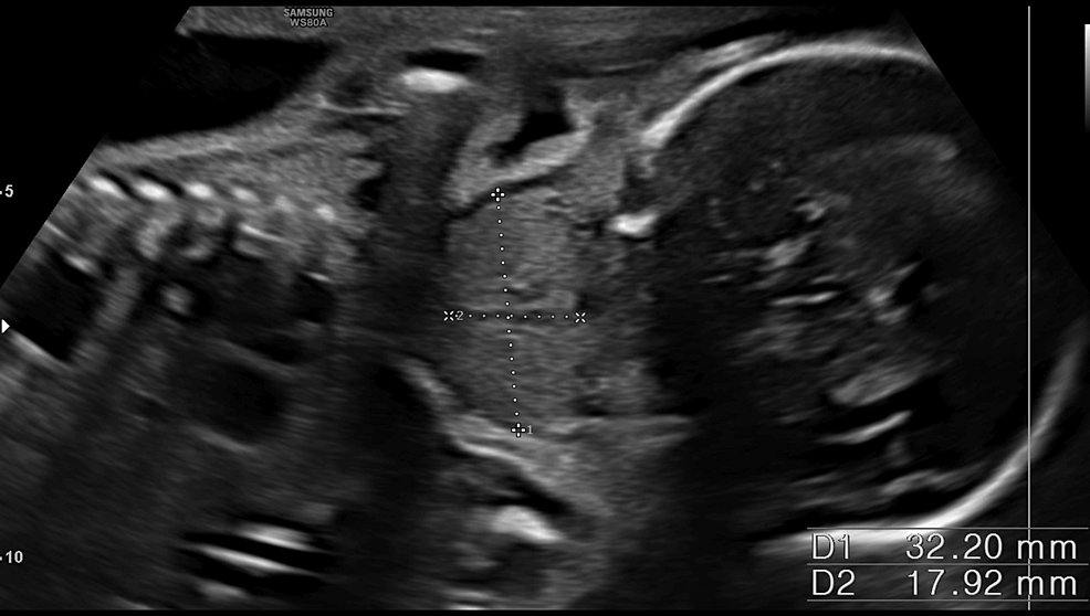 Cureus | Fetal Goiter Diagnosed in a Euthyroid Patient: An Unusual ...