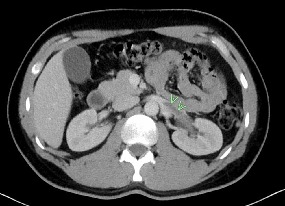 Treatment of renal vein thrombosis in patients with COVID-19 with apixaban: a case report
