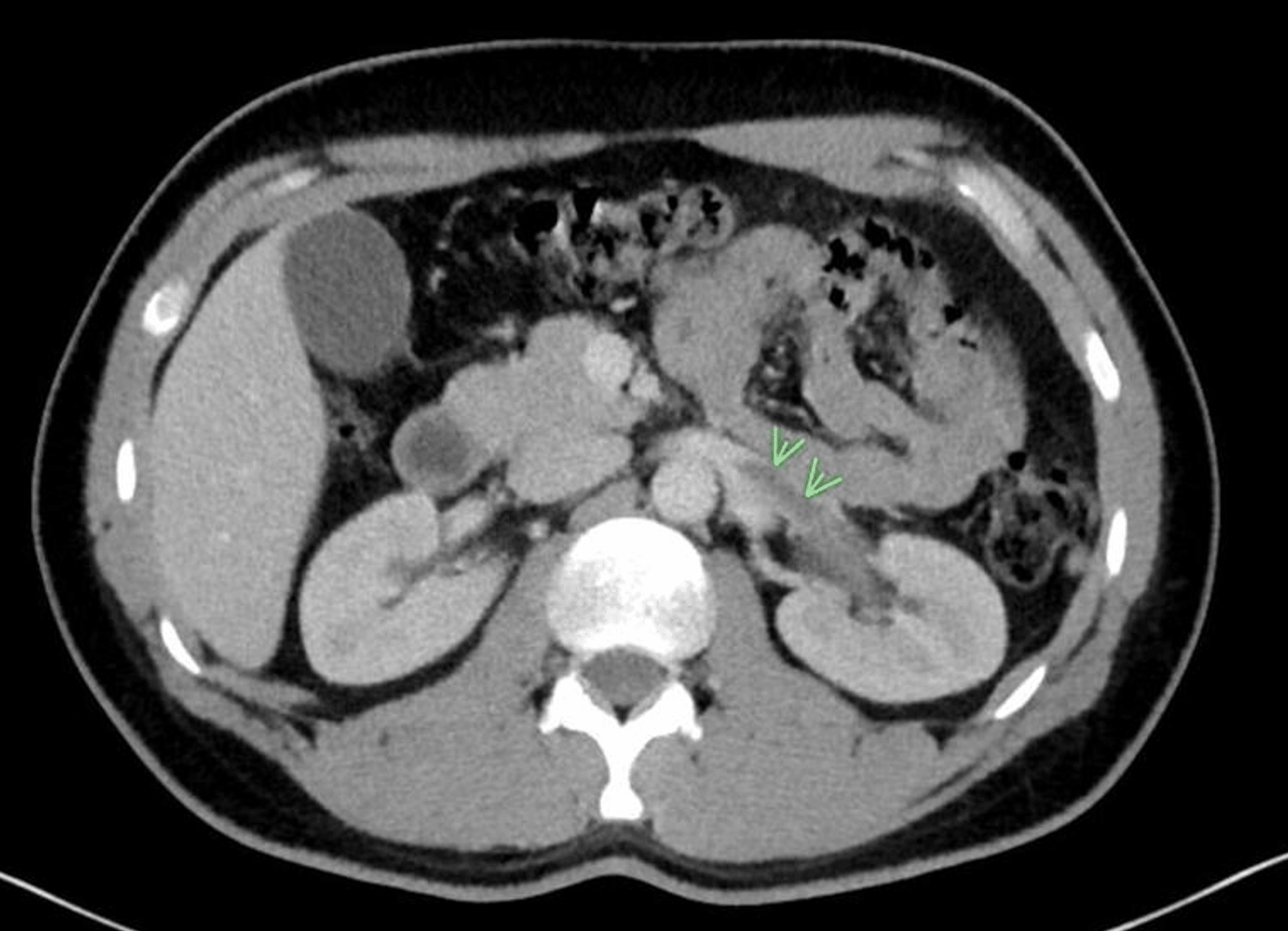 Cureus Renal Vein Thrombosis Treated With Apixaban in a Patient With