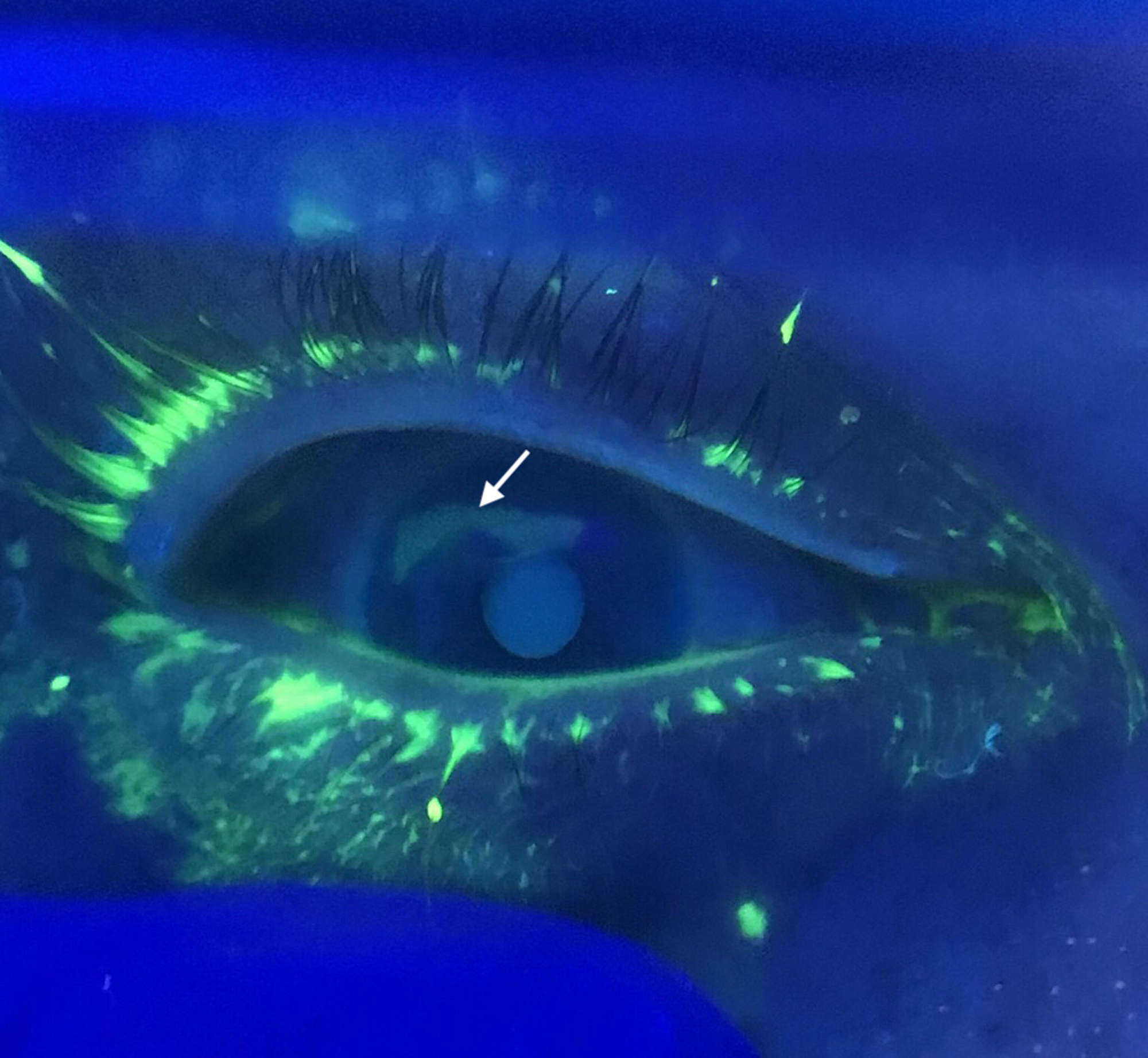 Cureus Traumatic Corneal Abrasion