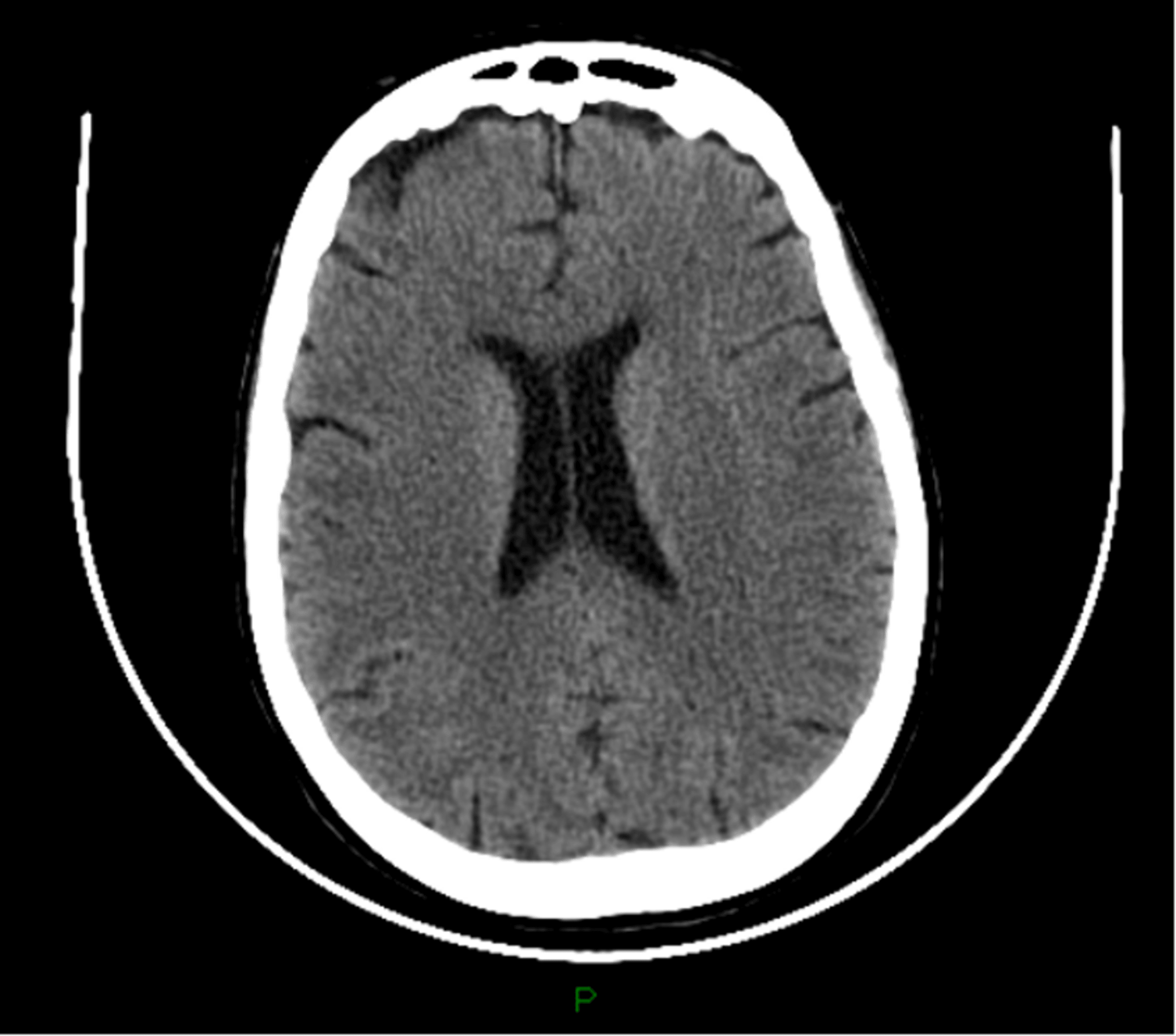 Psychosis and Seizures Attributed to Severe Vitamin B12 Deficiency A