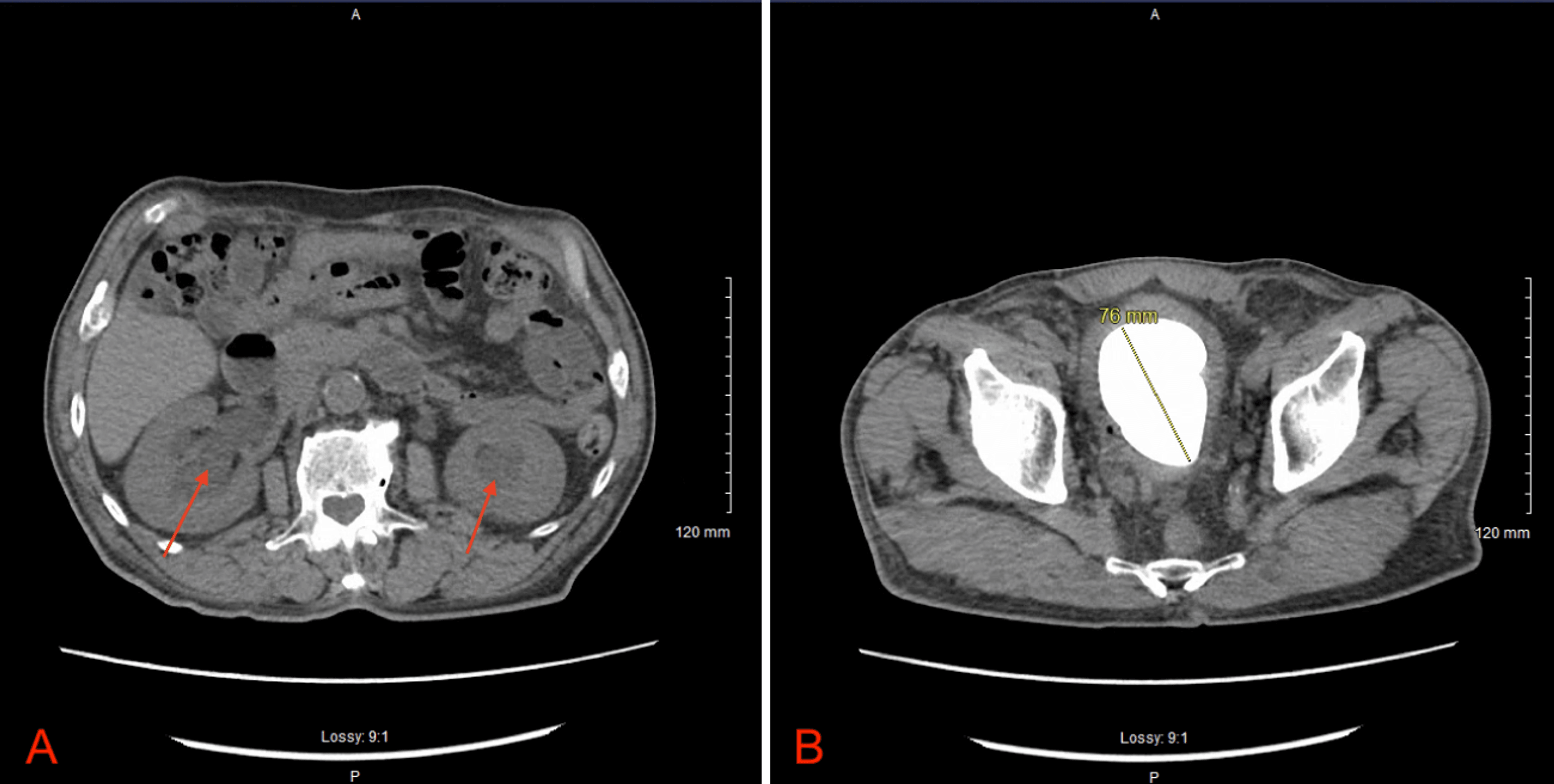 Cureus | A Rare Case Of A Giant Bladder Stone Associated With Post ...