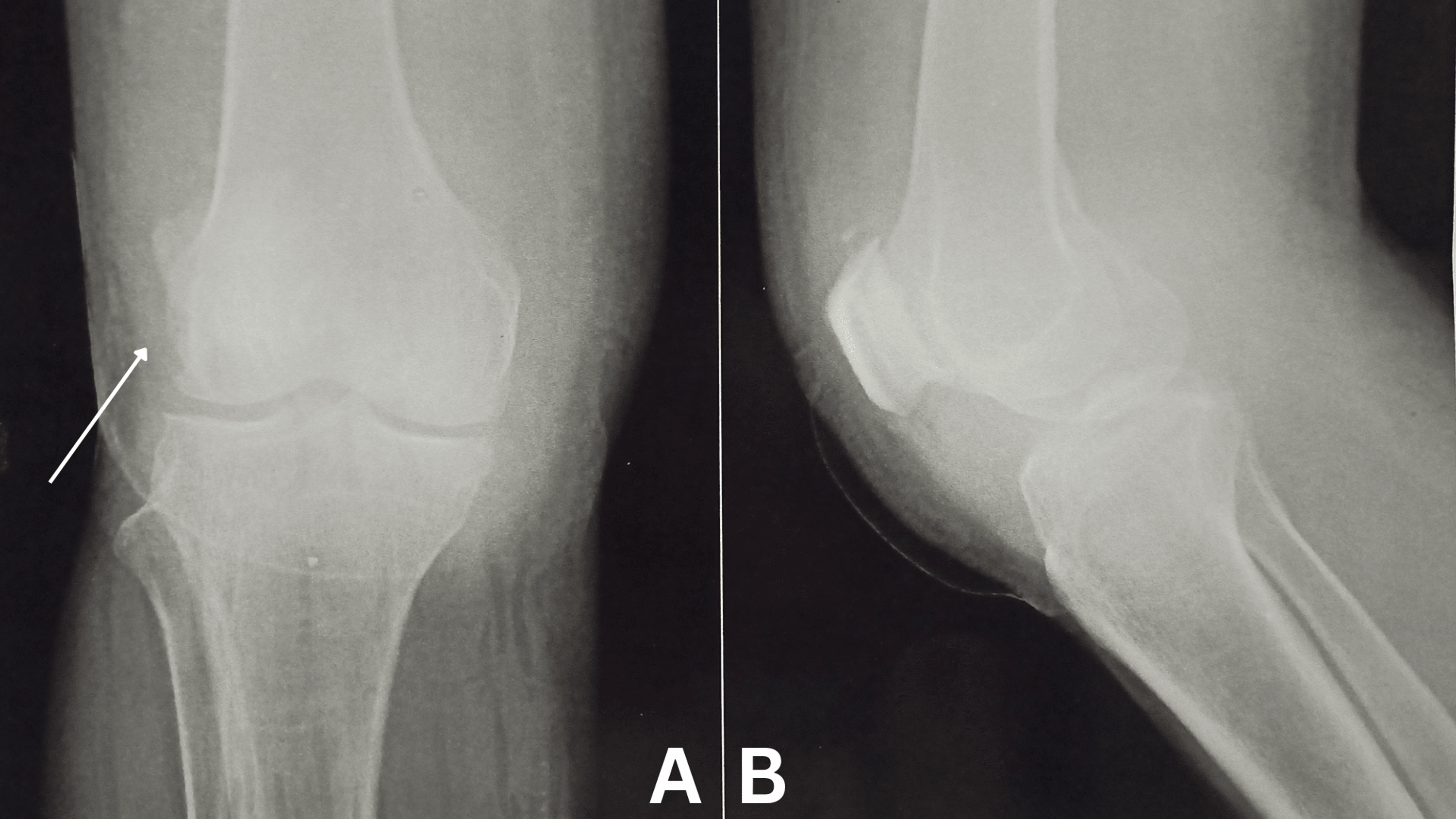 Cureus Physiotherapeutic Approach for Septic Arthritis of Knee Joint