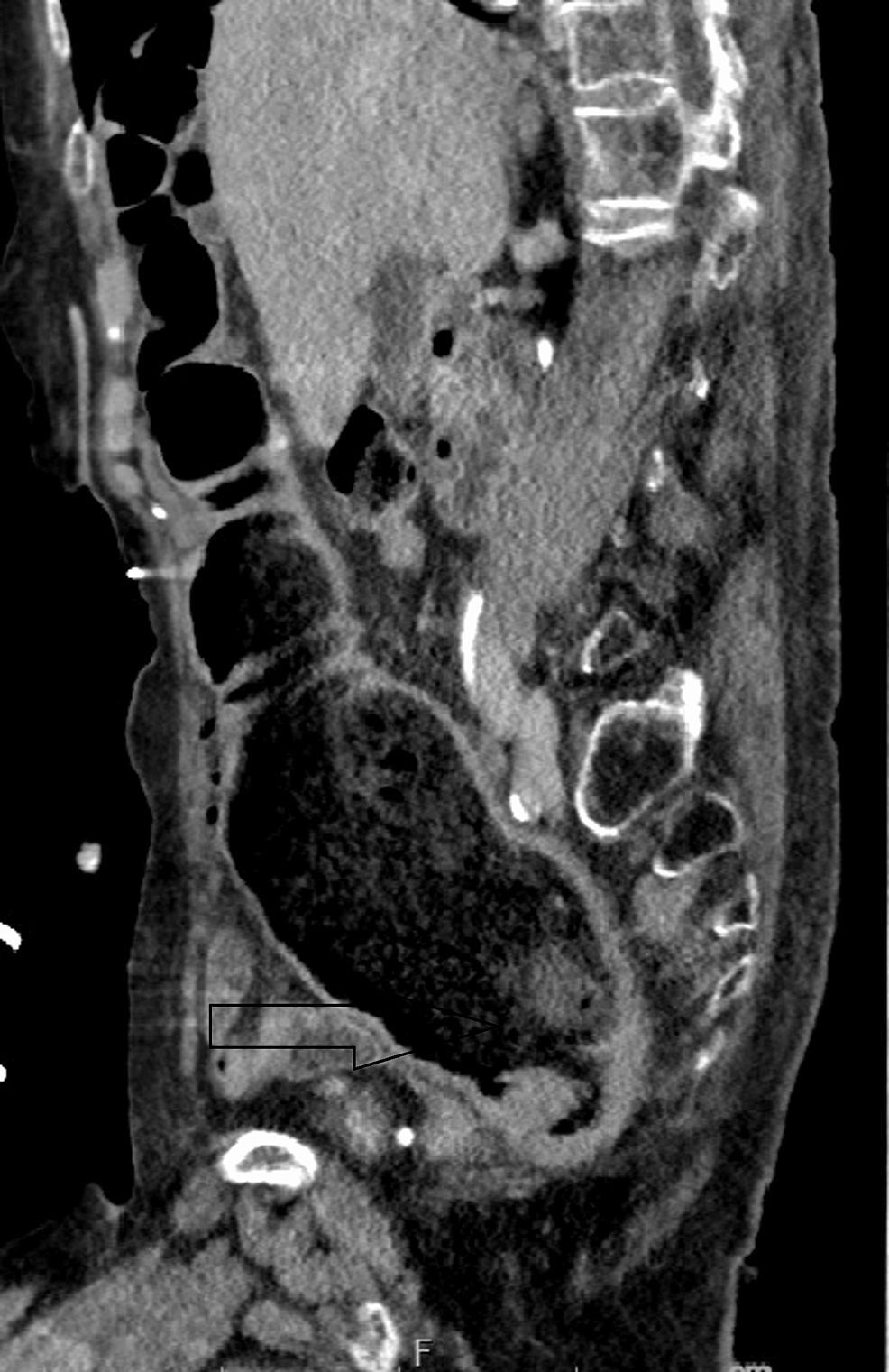 cureus-stercoral-colitis-a-diagnostic-challenge-and-therapeutic
