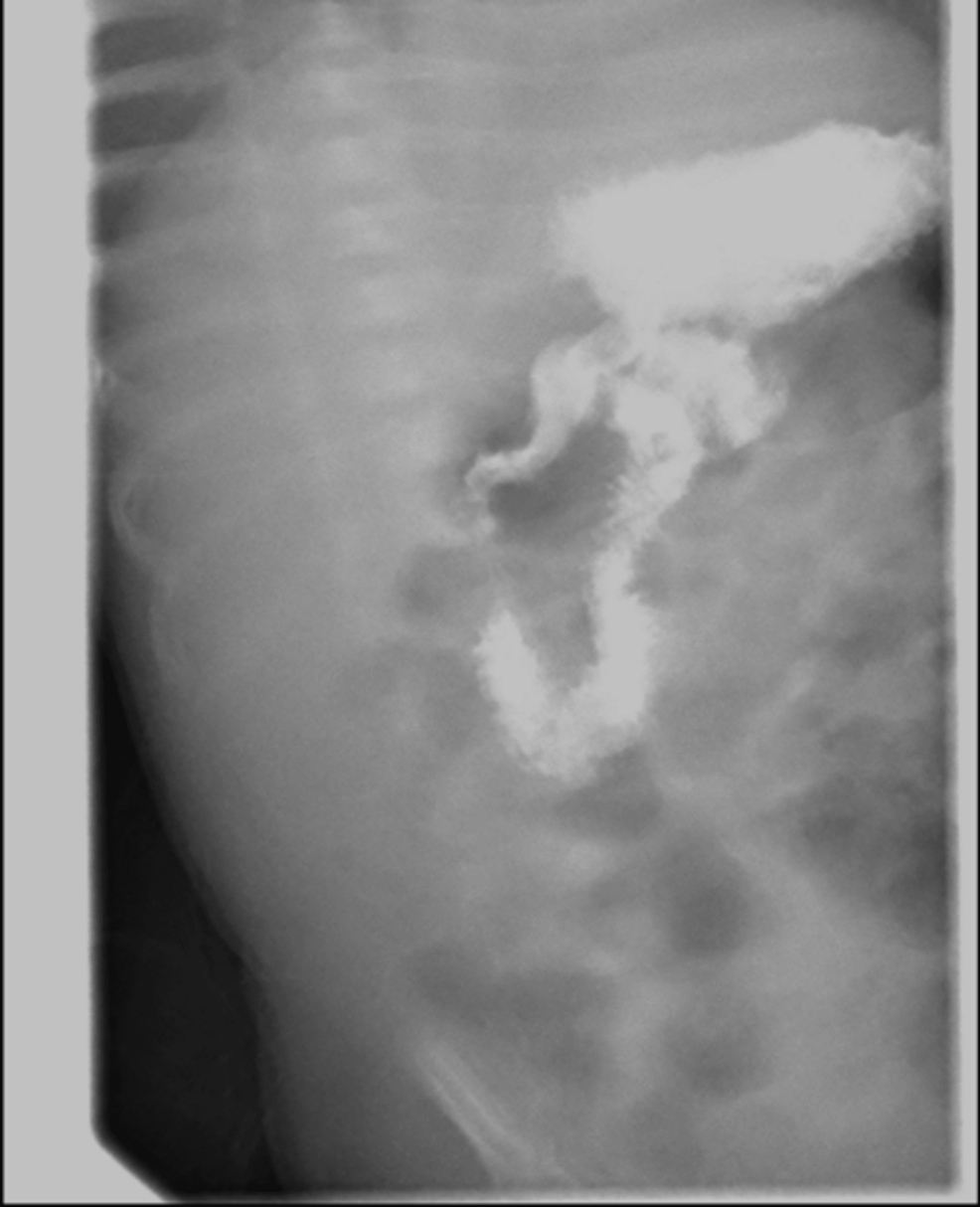 Cureus The Cause of Severe Metabolic Acidosis With Vomiting in a Neonate