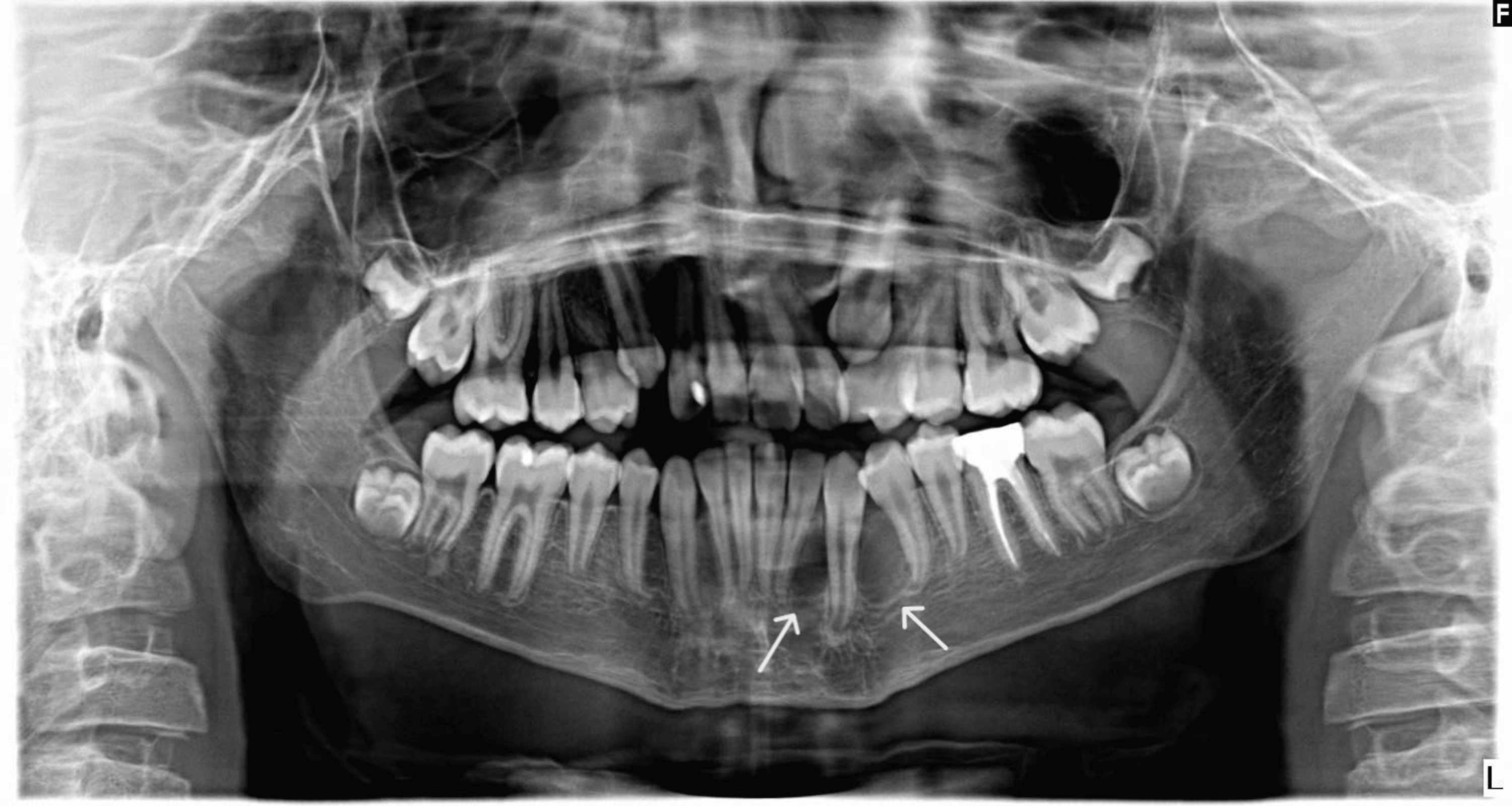 Odontogenic Keratocyst Presented as MultiLocular Radiolucency in