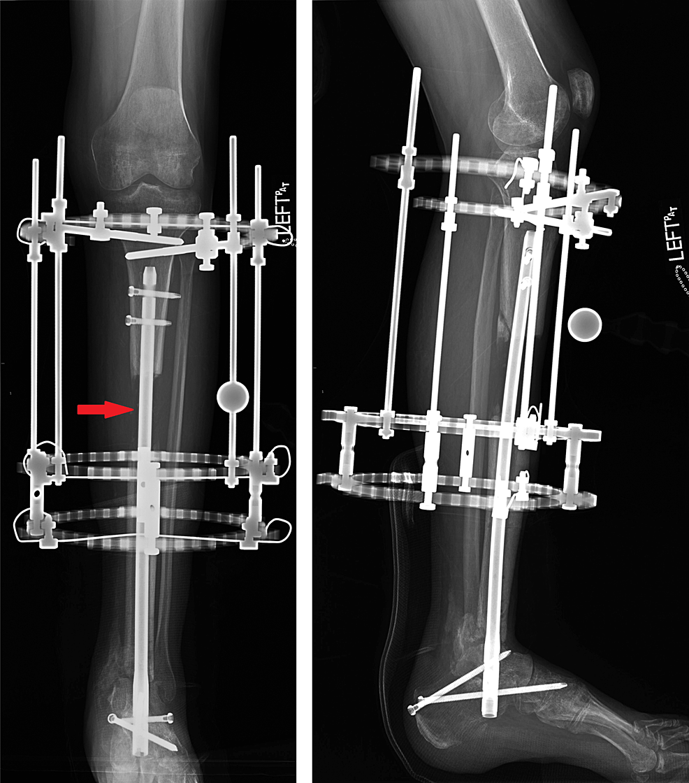 Analysis of bone transport for ankle arthrodesis as a limb salvage