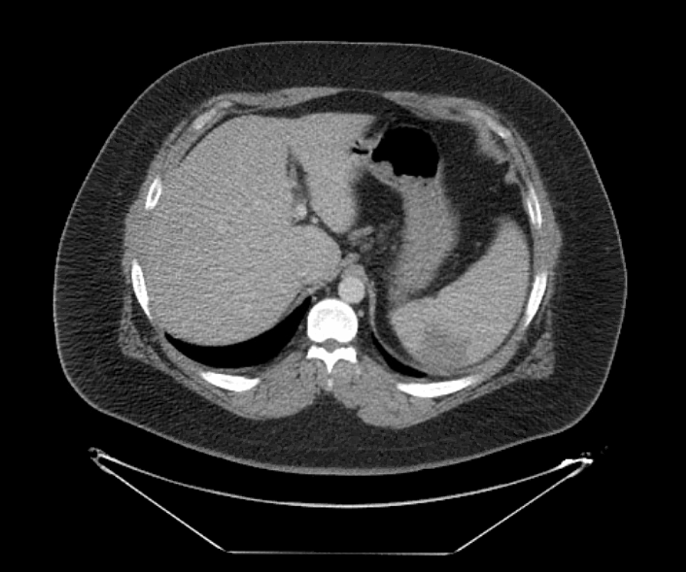 Infectious MononucleosisInduced Splenic Infarction Perhaps More