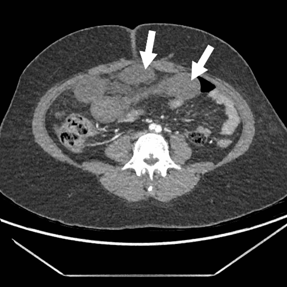 Cureus | Post-appendectomy Adhesive Small Intestine Obstruction With ...