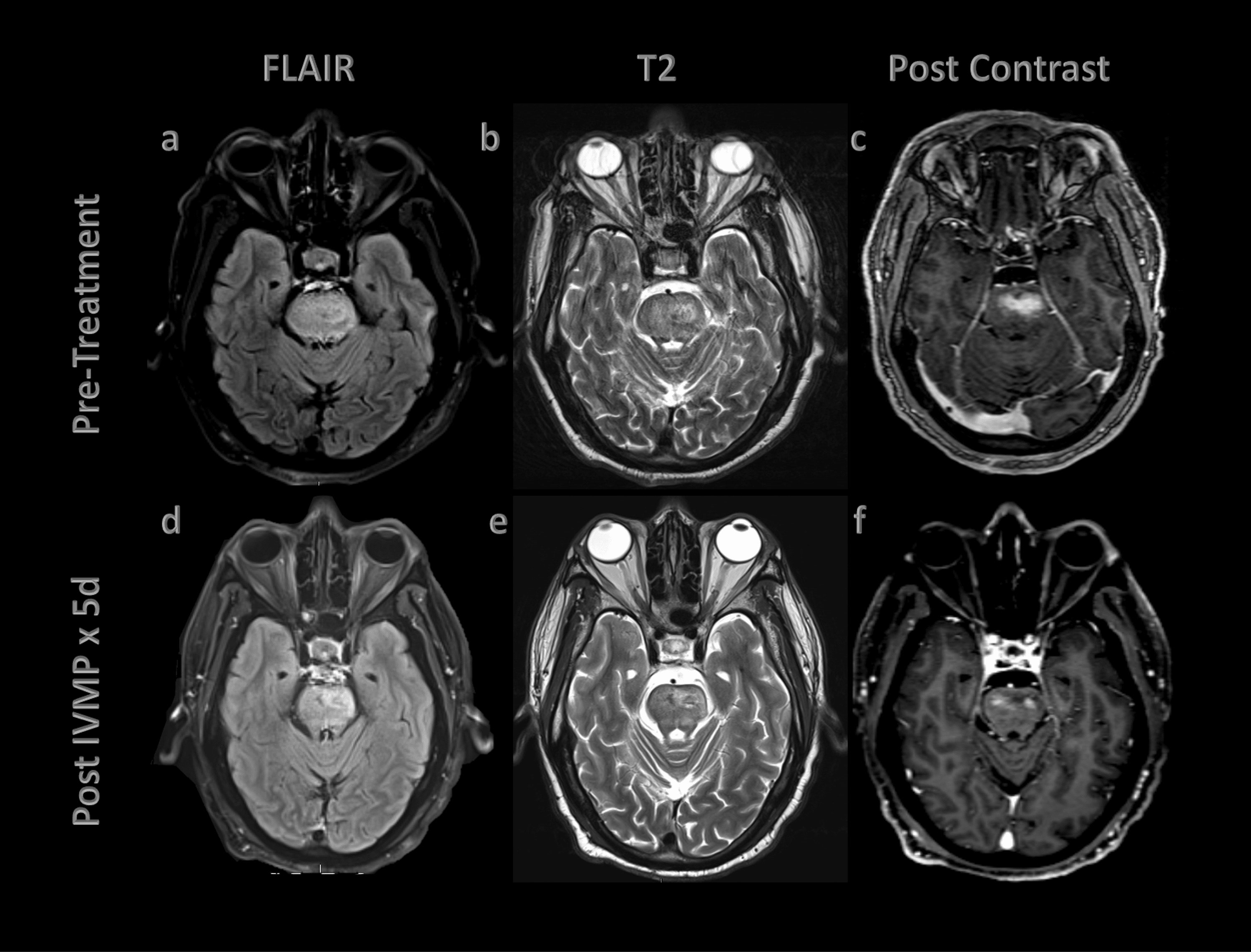 Cureus A Case of Radiologically Compatible Chronic Lymphocytic Inflammation With Pontine