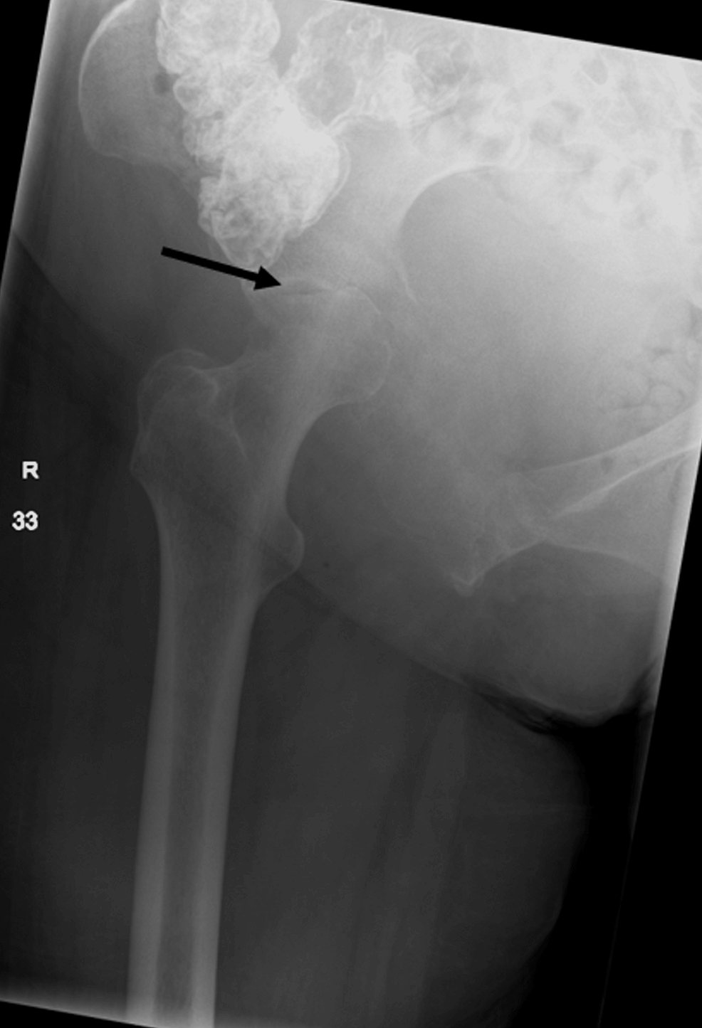 Unmasking Nonsmall Cell Lung Cancer The Unusual Trail of Hip Pain and