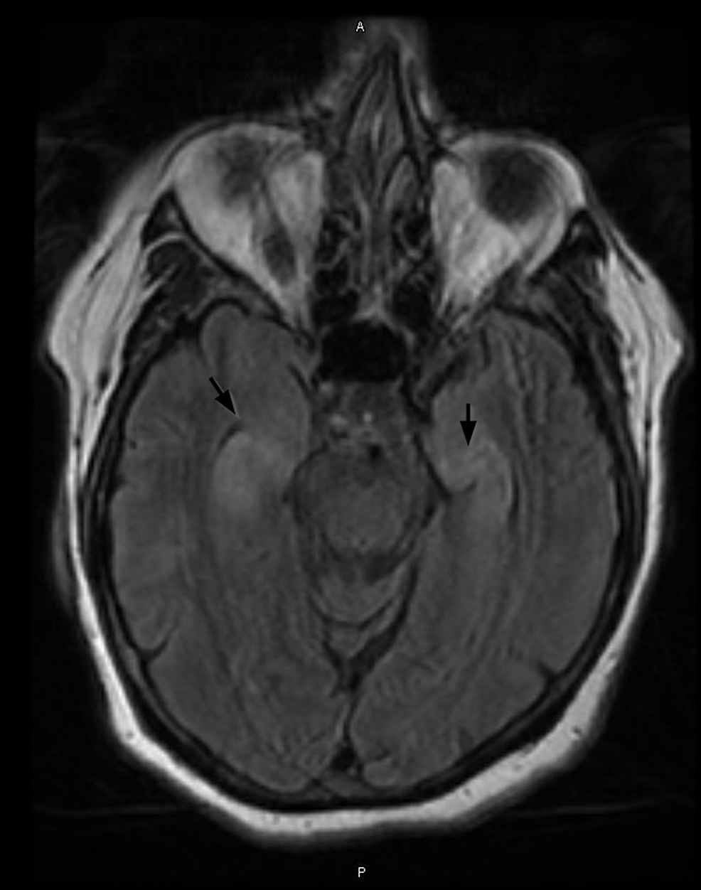 Rare Case of Anti-LGI1 Limbic Encephalitis with New Onset Epilepsy: A ...