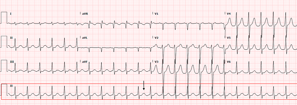 Cureus | Cardiac Amyloidosis Disguised as Atrial Flutter: A Case Report