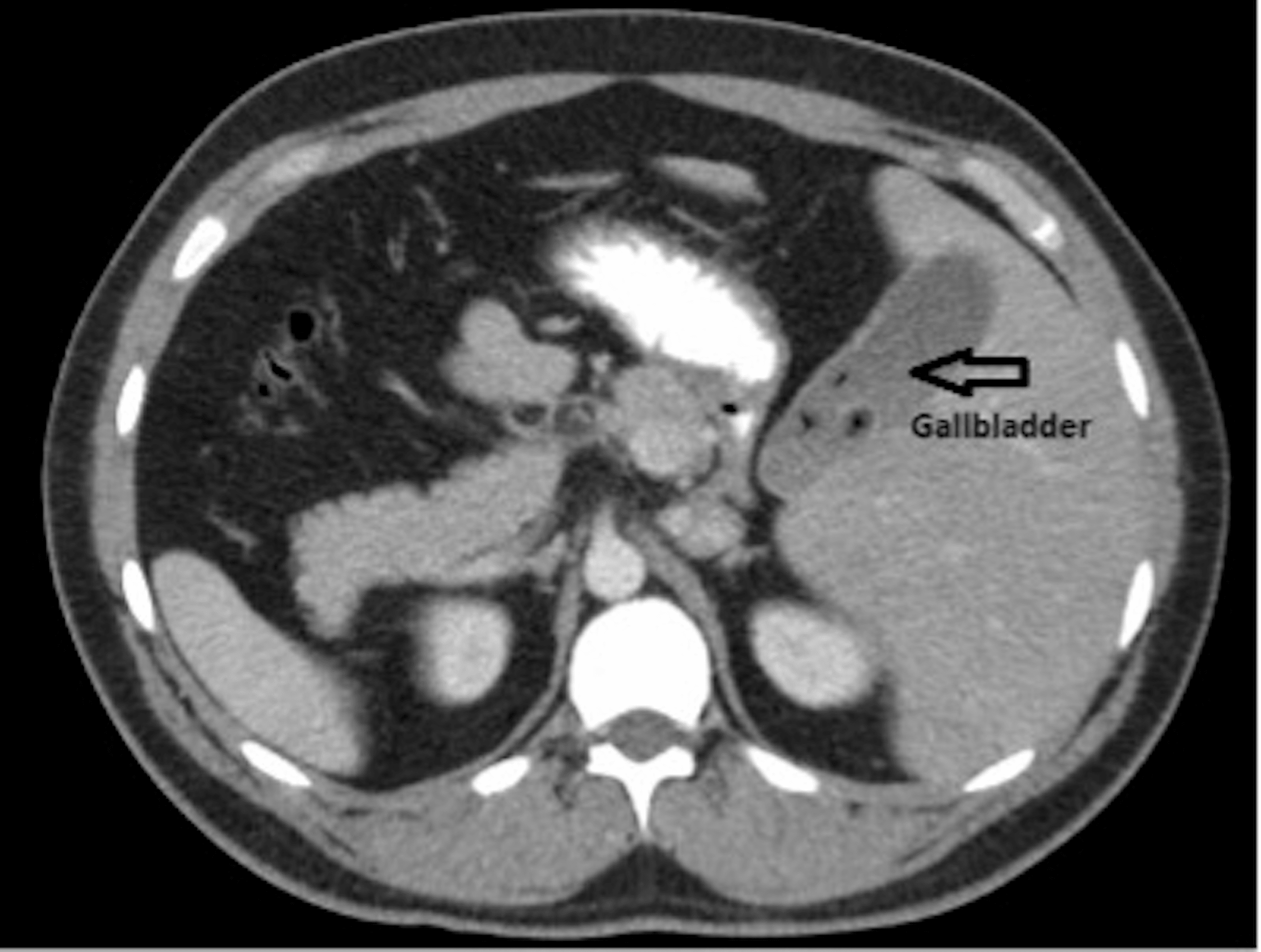 Cureus | Laparoscopic Cholecystectomy in a Patient With Situs Inversus ...