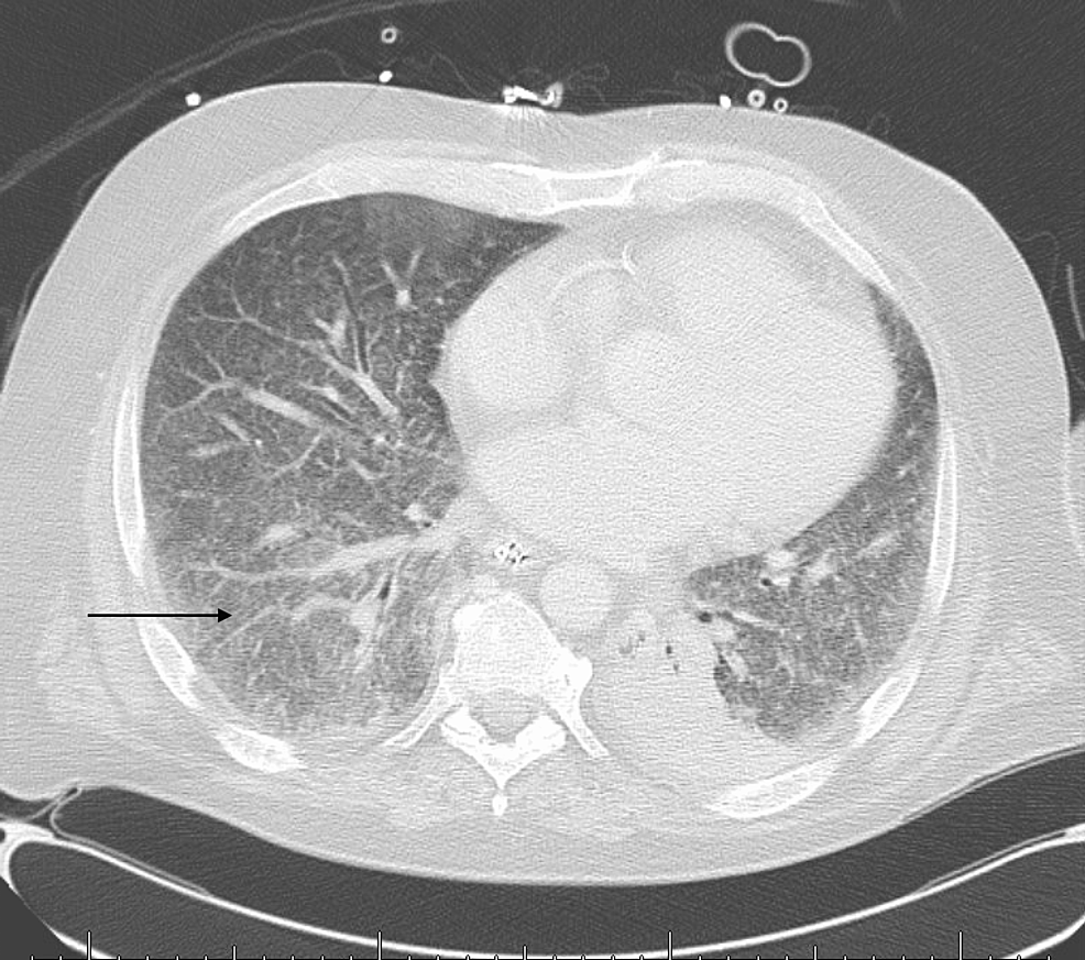 cureus-a-rare-case-of-disseminated-histoplasmosis-in-an-adult-with