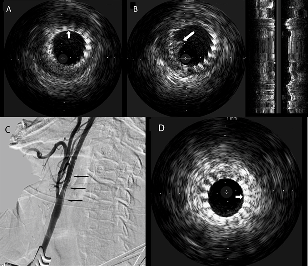 Cureus | Utility Of Intravascular Ultrasound During Carotid Angioplasty ...