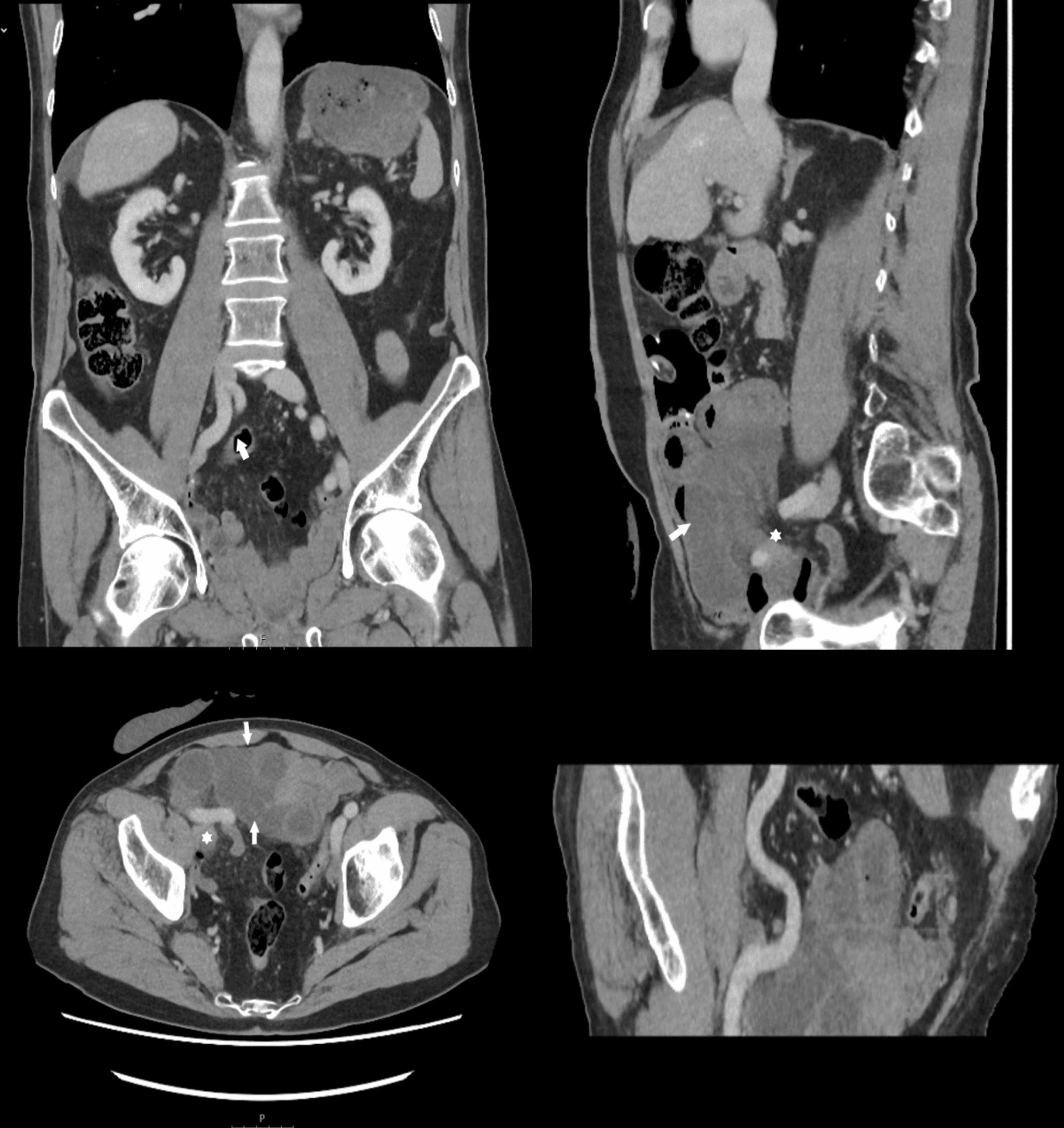 Cureus Strangulated Small Bowel Internal Hernia Under The External Iliac Artery After Robotic 6825