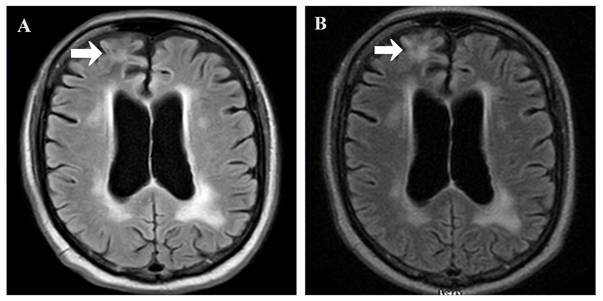 Cureus Efficacy of Pembrolizumab and Nivolumab in Crossing the Blood