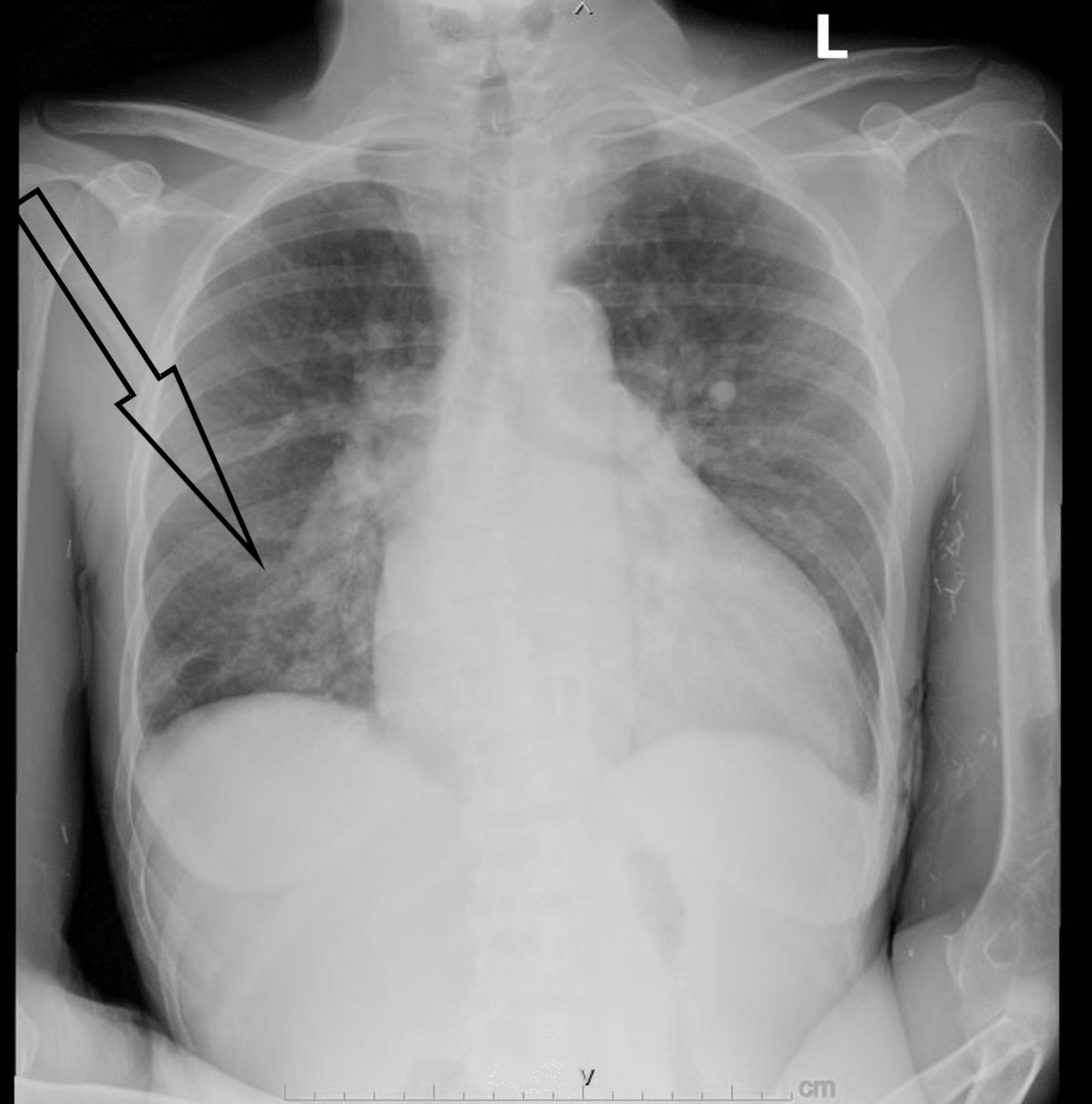 Cureus Staphylococcus lugdunensis Infective Endocarditis With Mitral