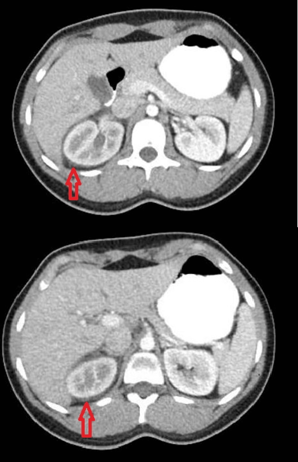 Kidney Pain or Renal Colic - Causes and Treatment - Best Urologist in  Manhattan - Treatment of Urological Pain Syndromes