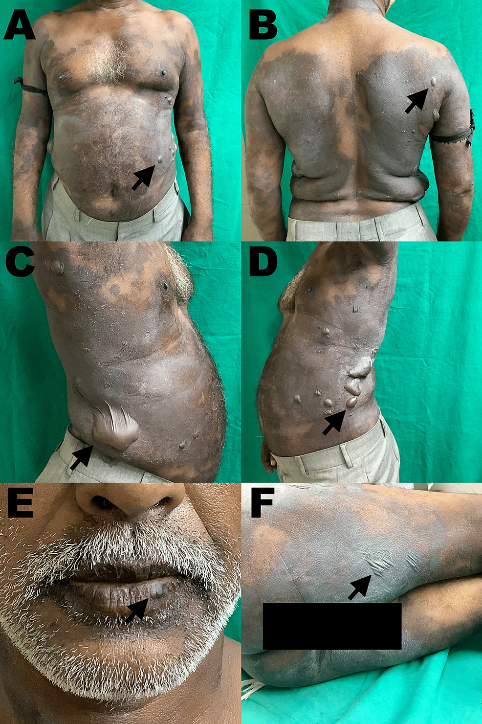 Cureus Tadalafil Induced Generalized Bullous Fixed Drug Eruption