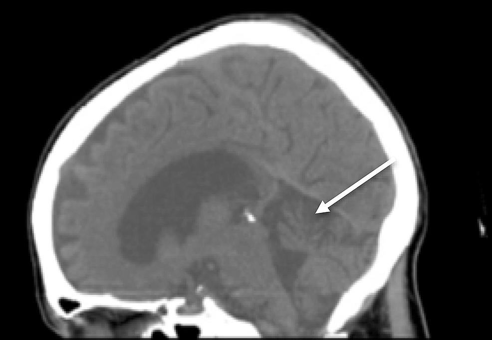 Midsagital-CT-of-the-head-