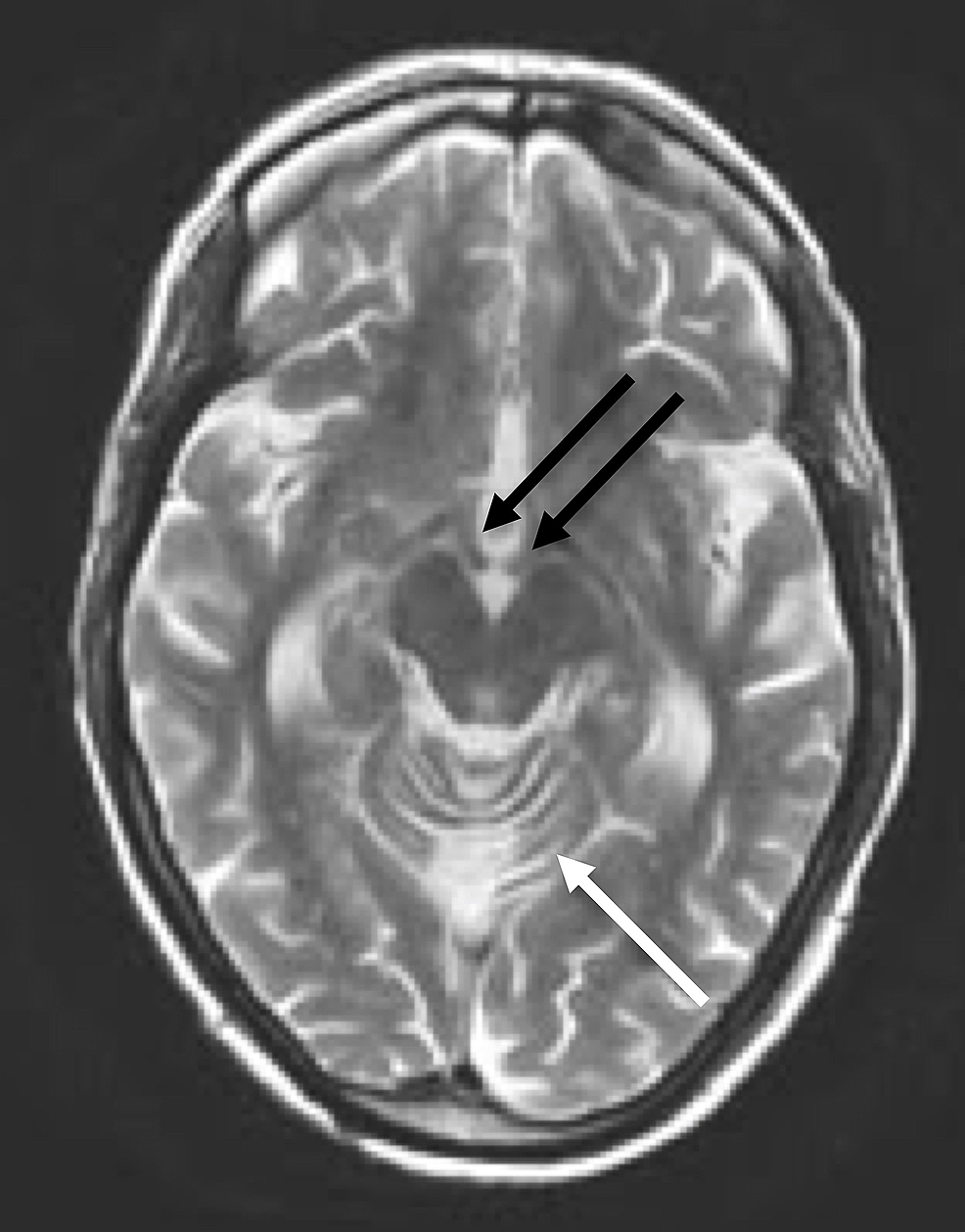 Axial-T2-weighted-MRI-of-the-head-