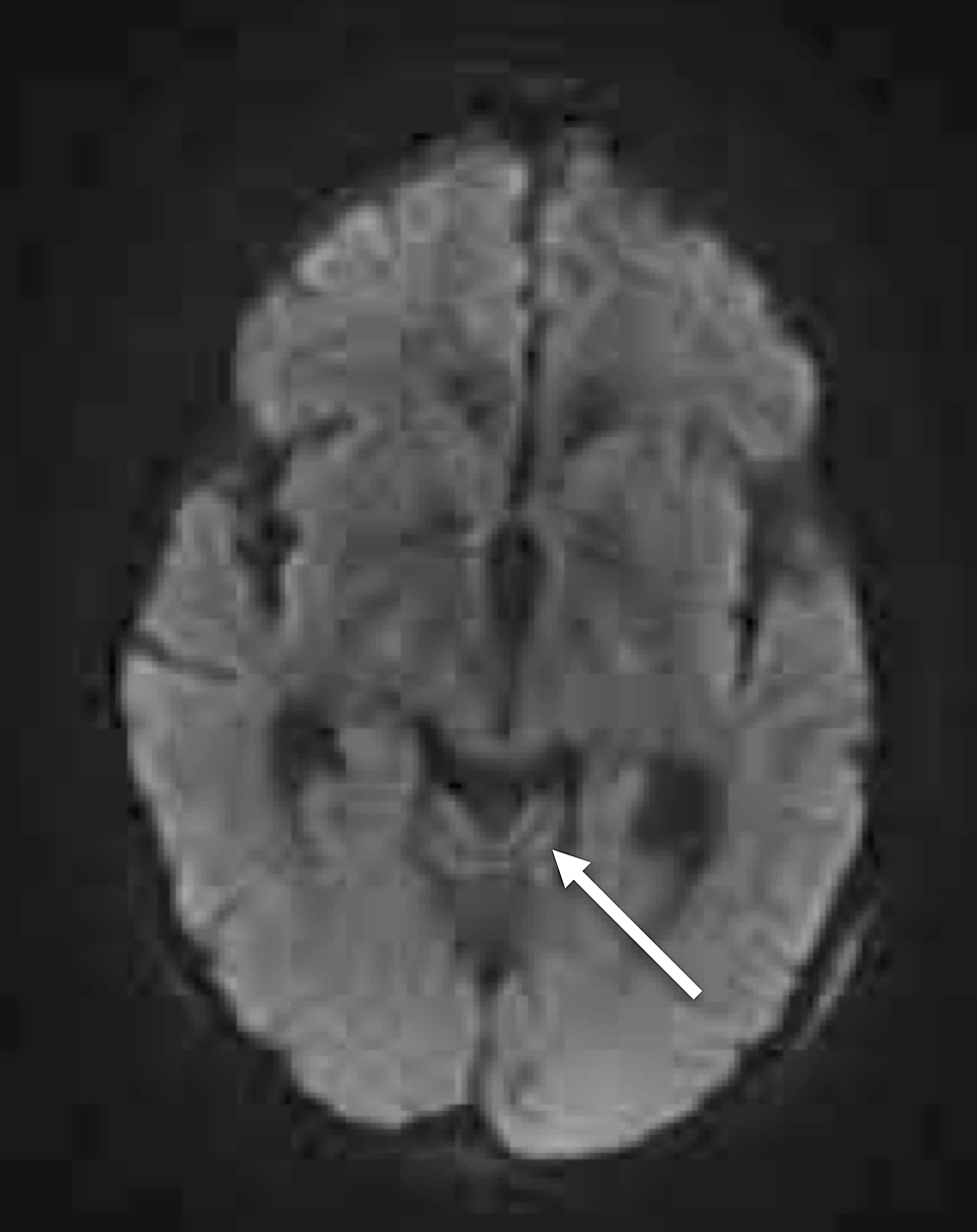 Axial-DWI-of-the-head