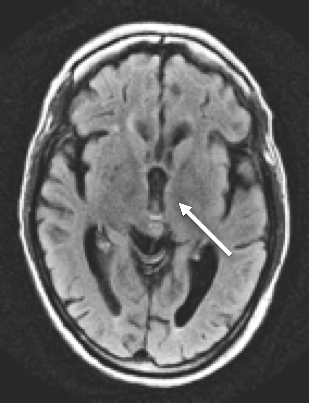 Axial-FLAIR-MRI-of-the-head