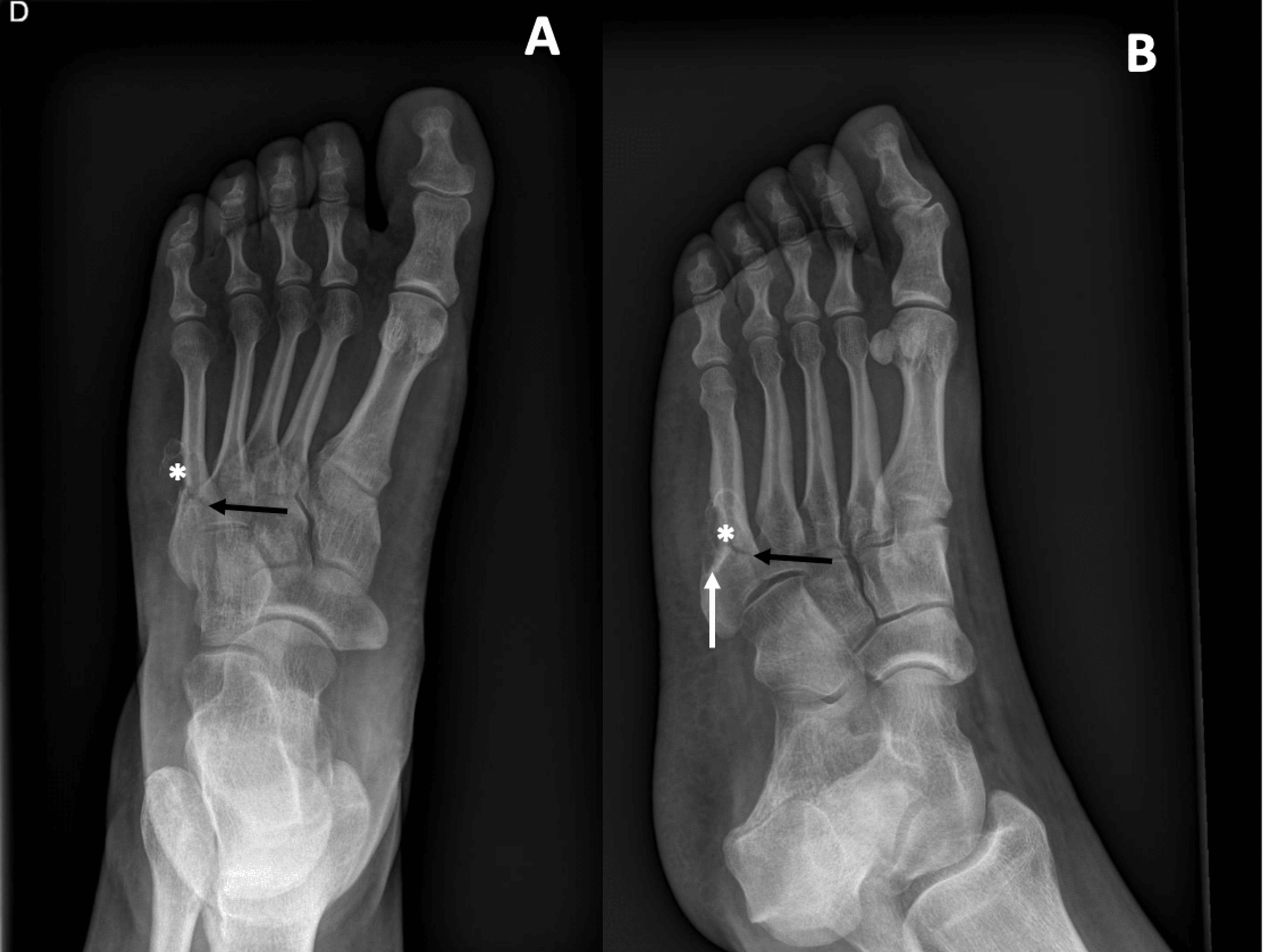 Cureus Spontaneous Fracture of the Fifth Metatarsal Secondary to Gout