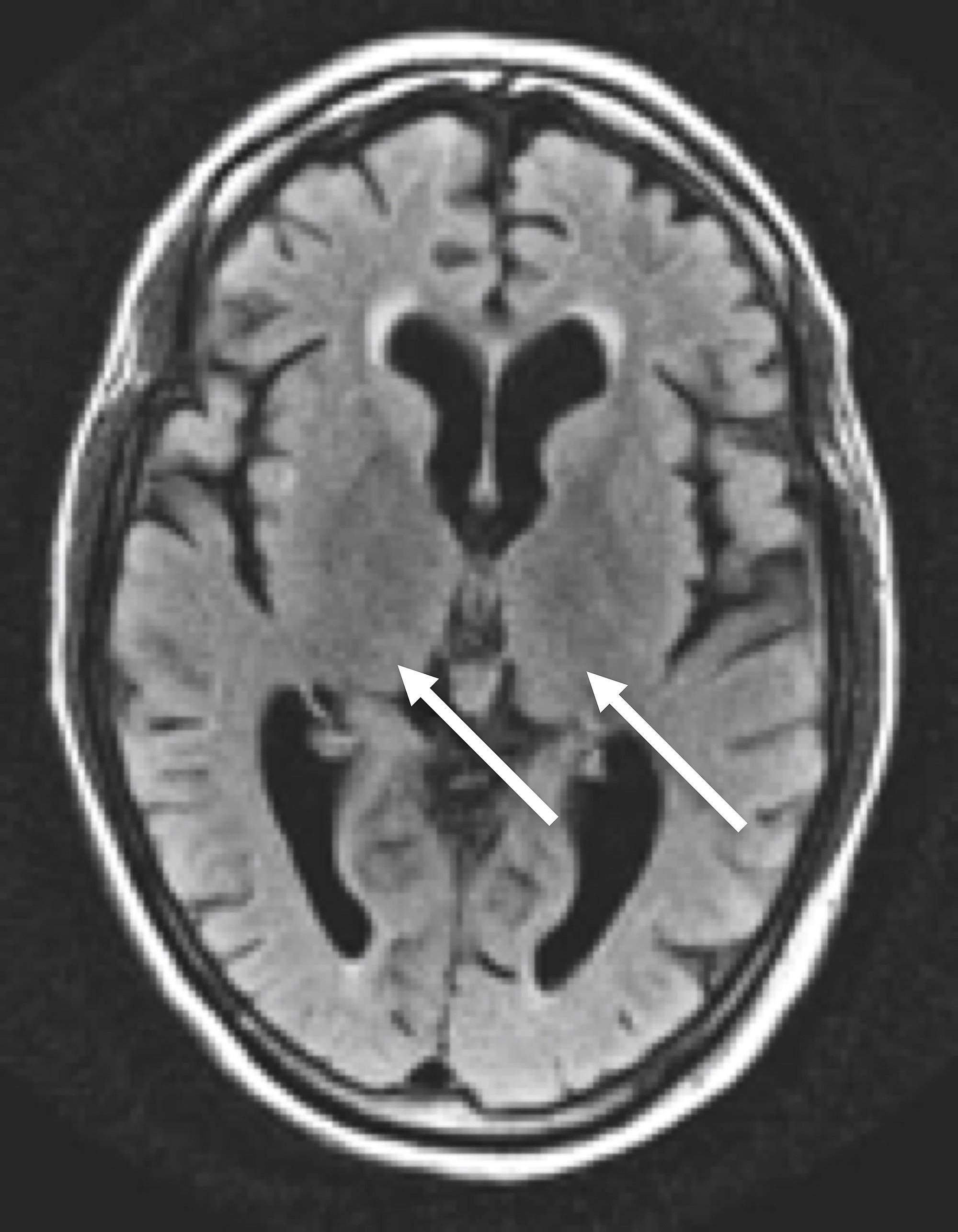 Cureus | Alcohol Induced Wernicke Encephalopathy with Atypical MRI Findings