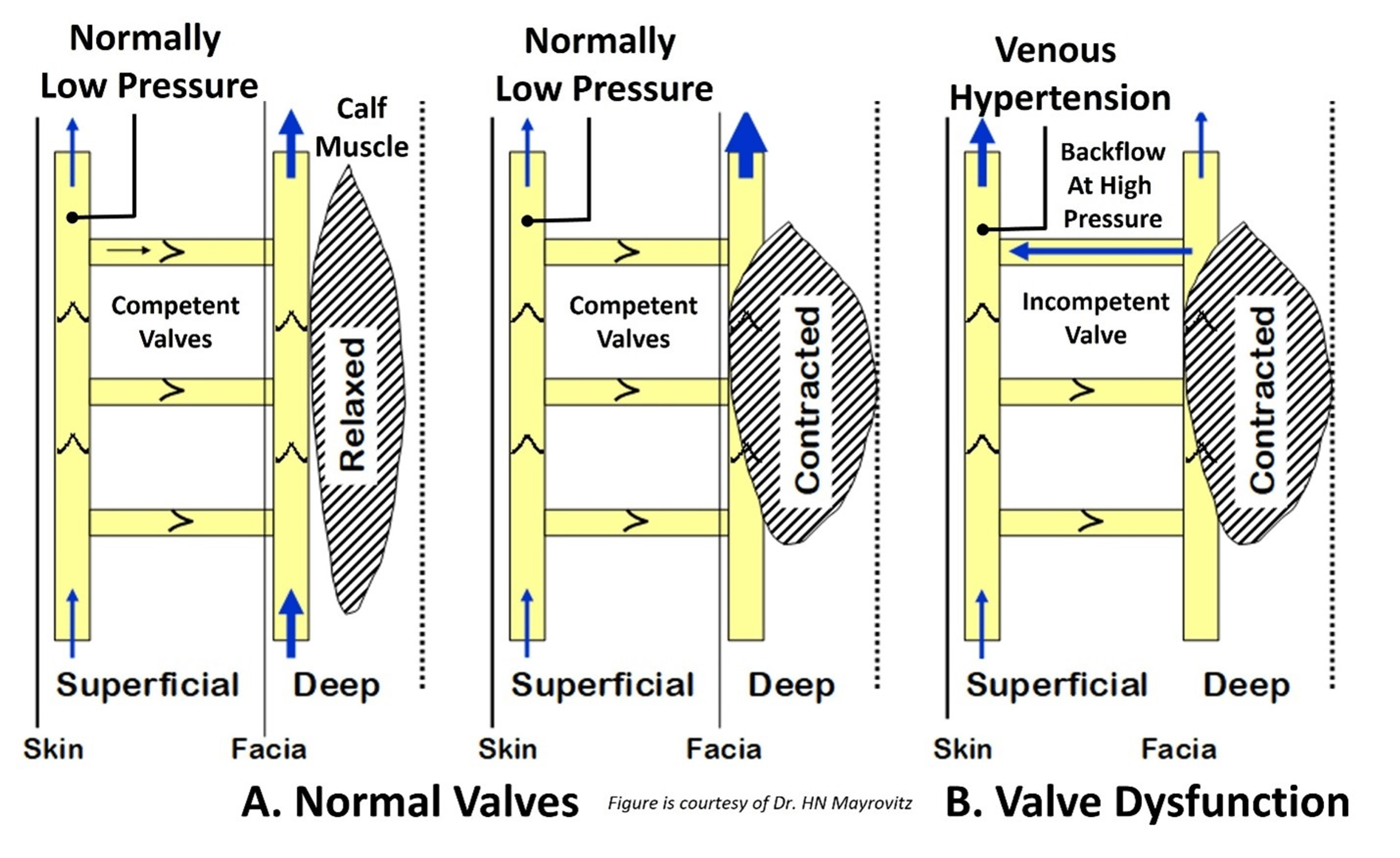 Cureus Chronic Venous Insufficiency With Emphasis on the Geriatric