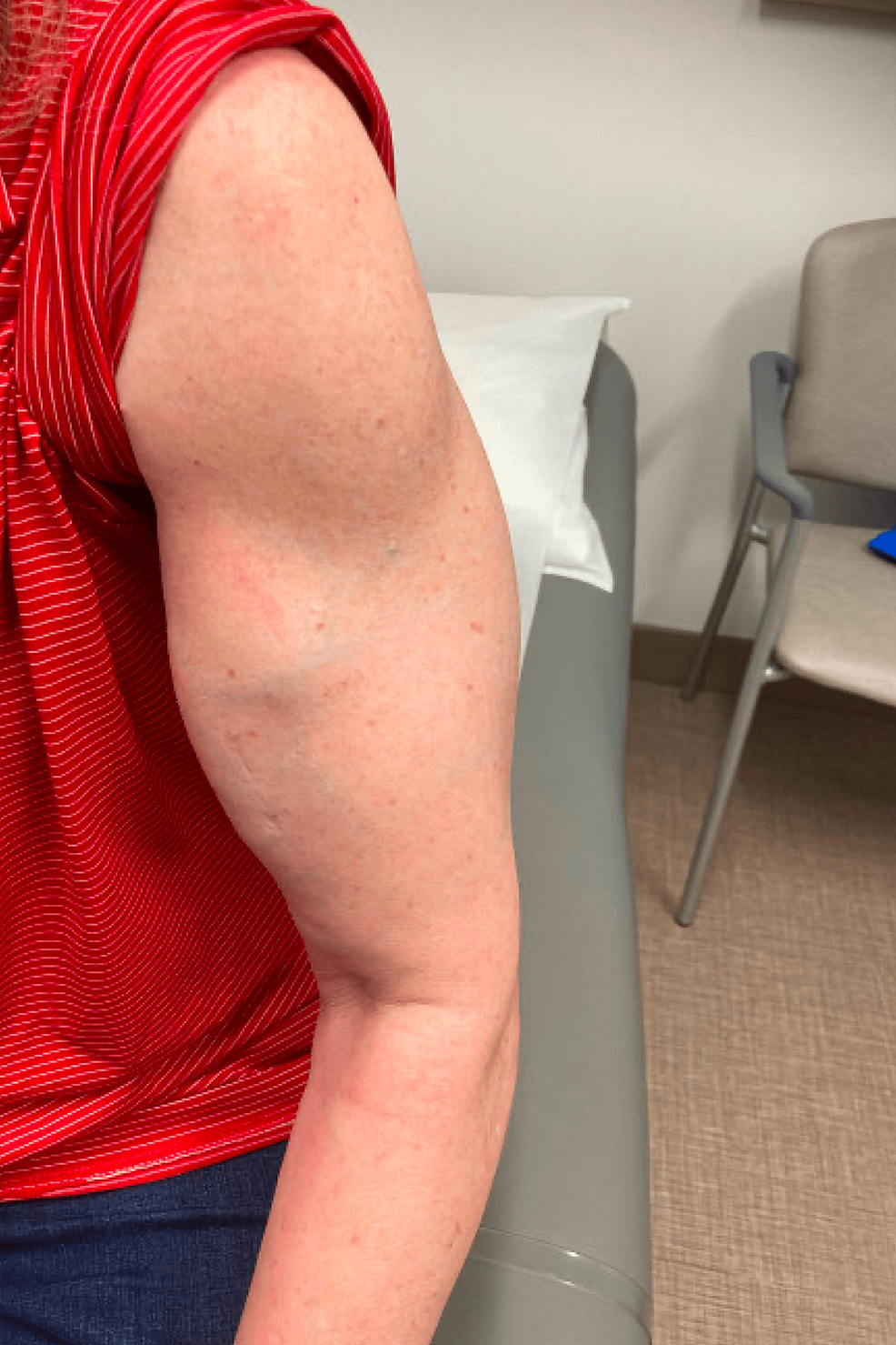 cureus-an-unusual-presentation-of-dermatomyositis-with-muscle-hypertrophy