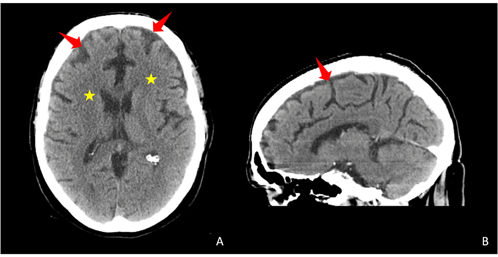 Cureus Dysesthesia and Depression in Undiagnosed Alzheimer's Disease