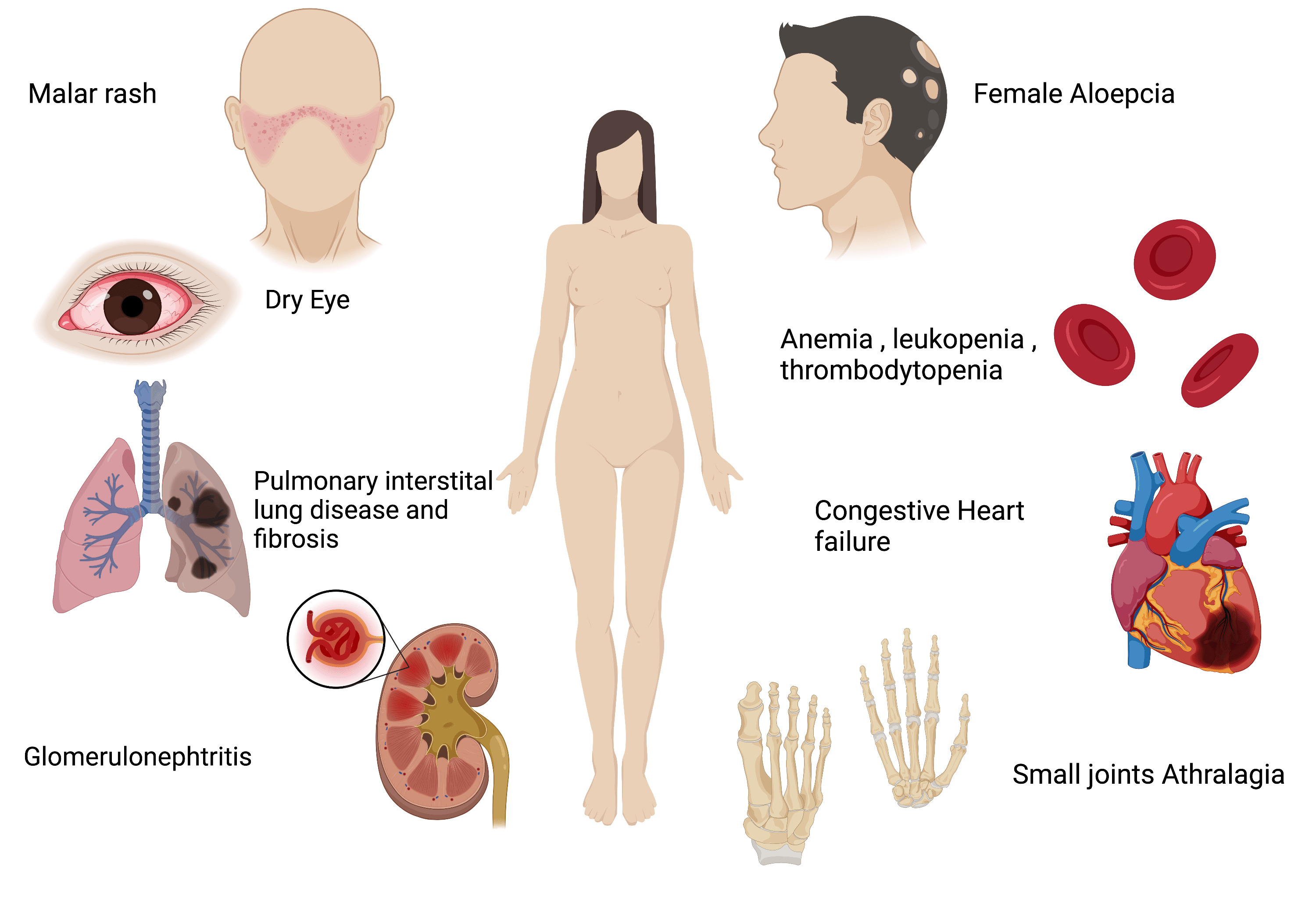 Cureus The Comorbidity of Endometriosis and Systemic Lupus