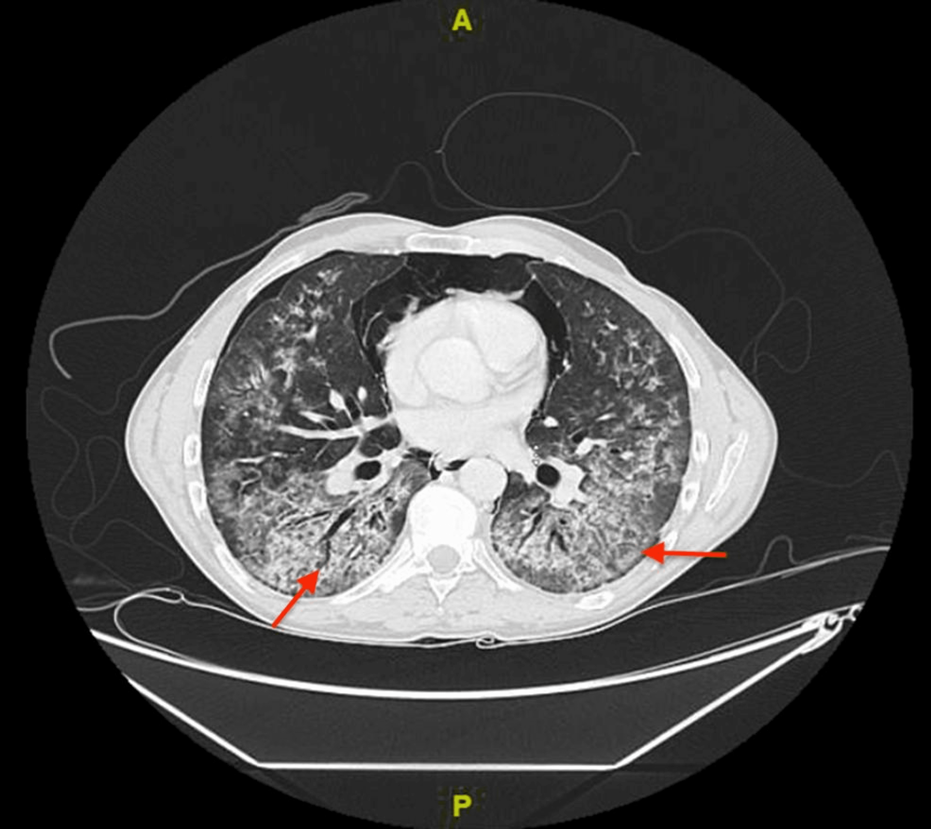 Cureus InfliximabInduced Interstitial Pneumonitis A Case Report