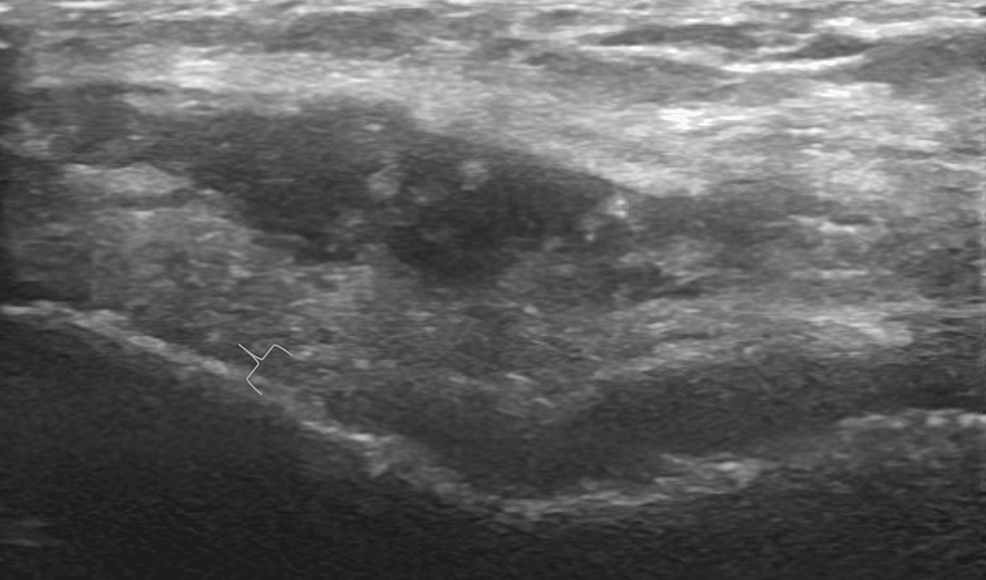 Cureus | Ultrasound Evaluation of Knee Osteoarthritis