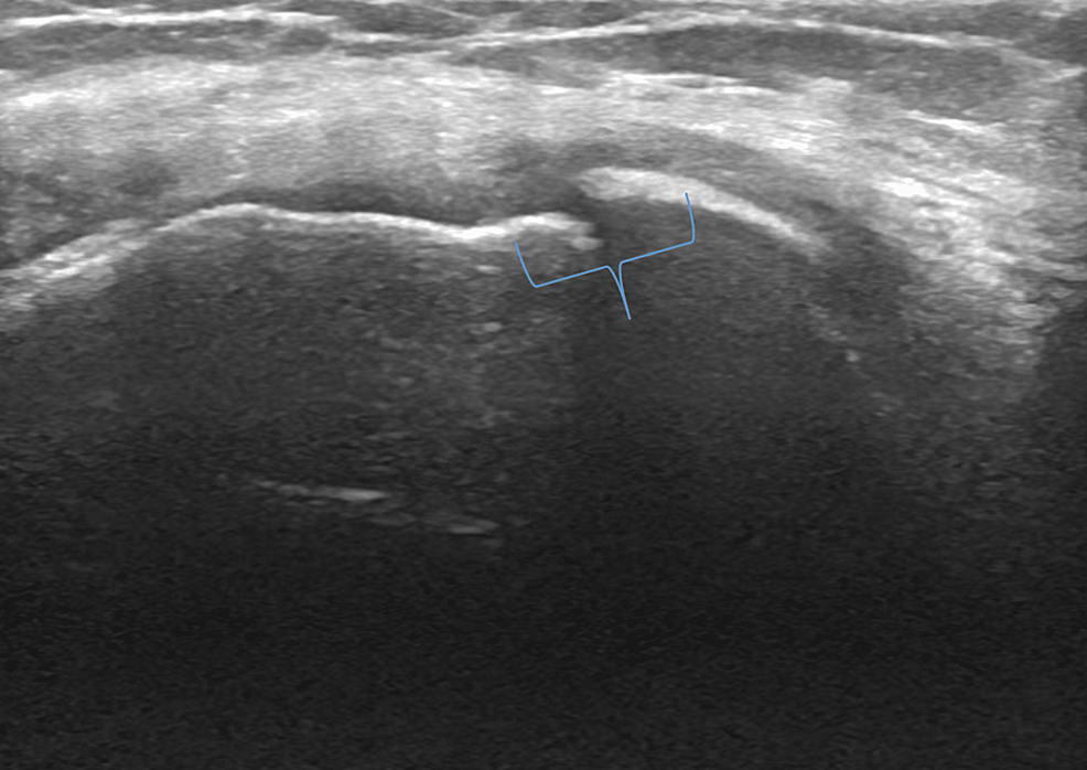 Cureus | Ultrasound Evaluation of Knee Osteoarthritis