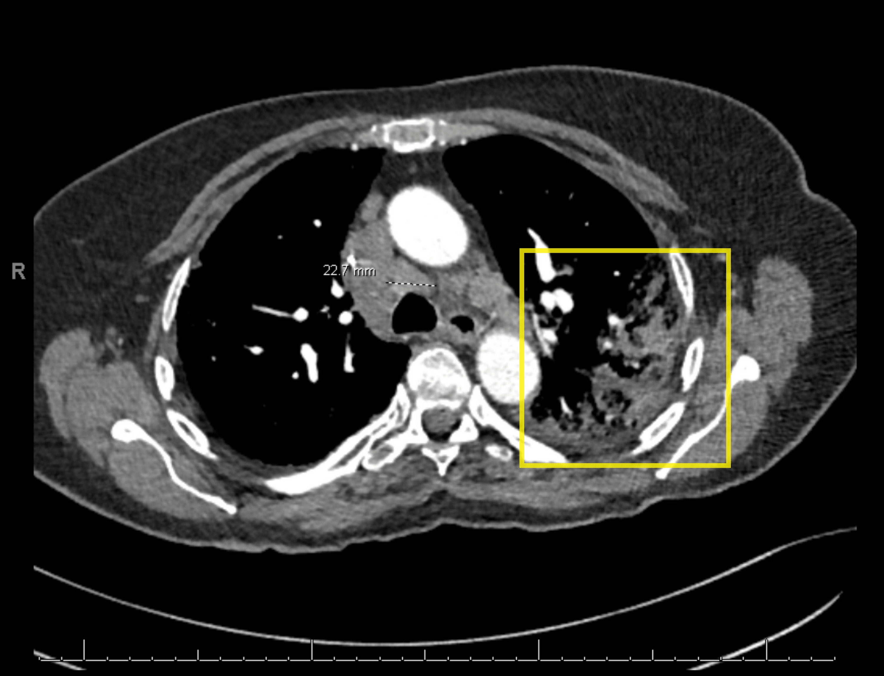 Cureus DaptomycinInduced Pulmonary Toxicity A Case Series