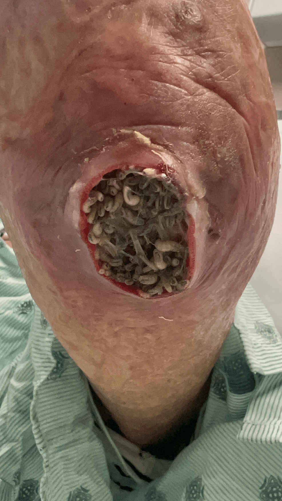 Cureus  Flesh Fly Maggot-Infected Abscess in a Burn Victim