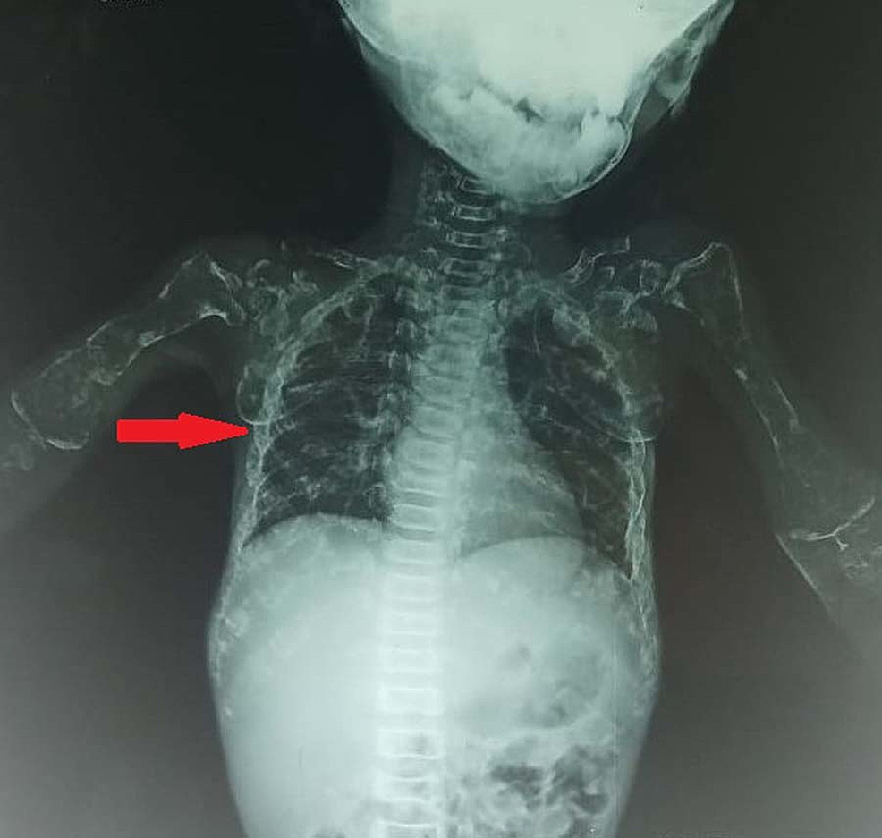 Cureus A Unique Association of Osteogenesis Imperfecta with Bilateral