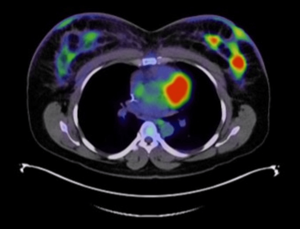 A Case Of Bilateral Inflammatory Breast Cancer Cureus