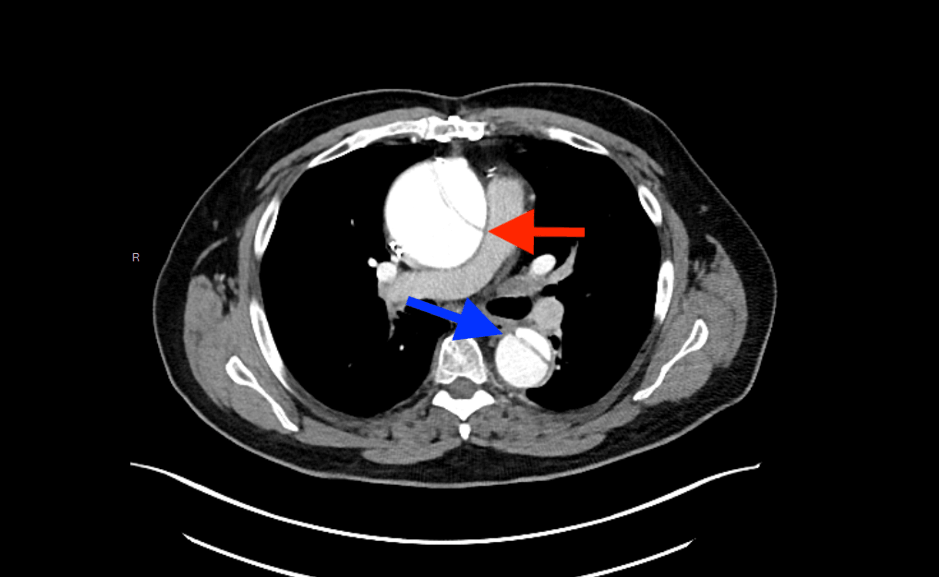 Cureus The Silent Threat A Case Of Iatrogenic Asymptomatic Aortic