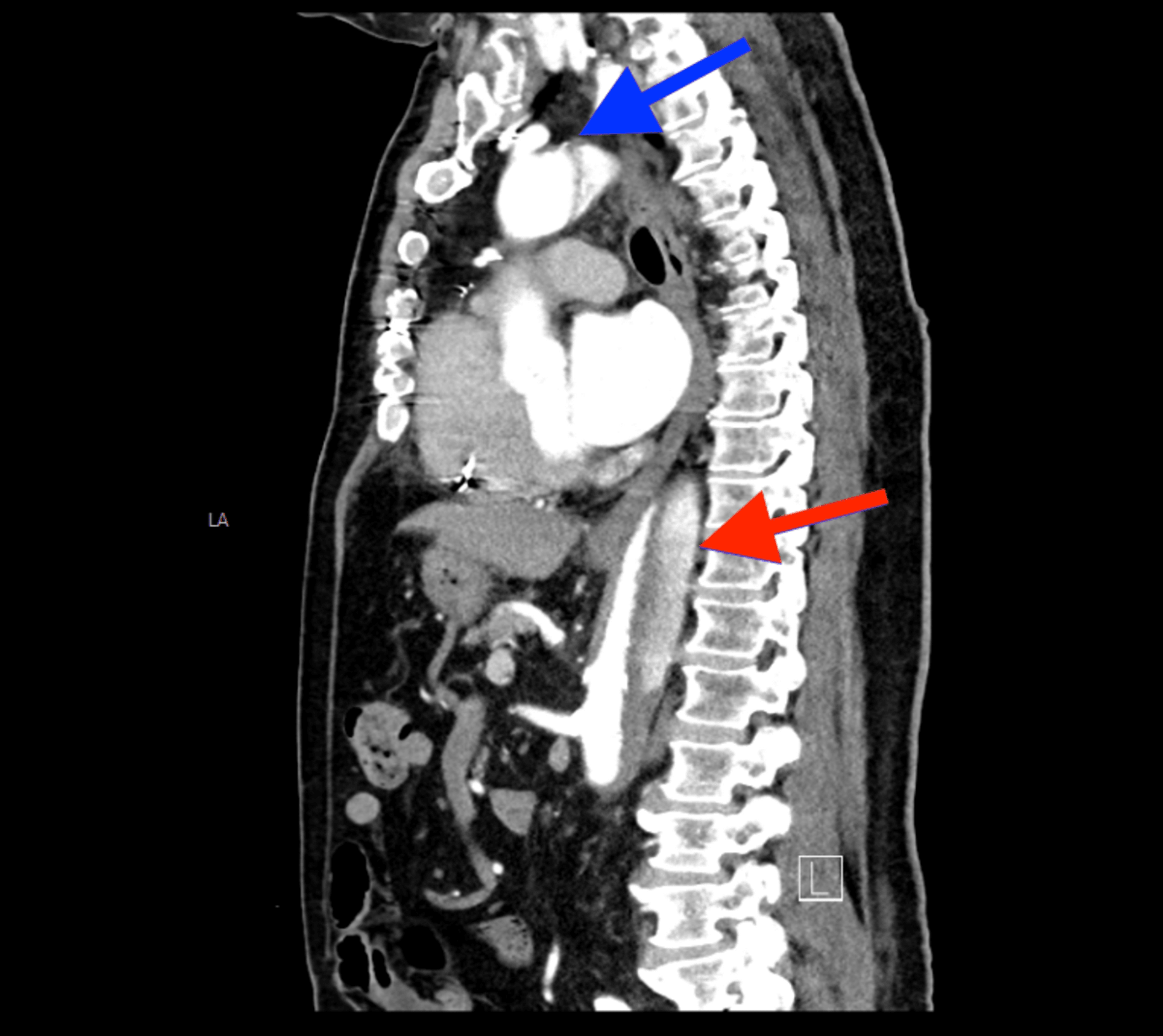 Cureus The Silent Threat A Case Of Iatrogenic Asymptomatic Aortic